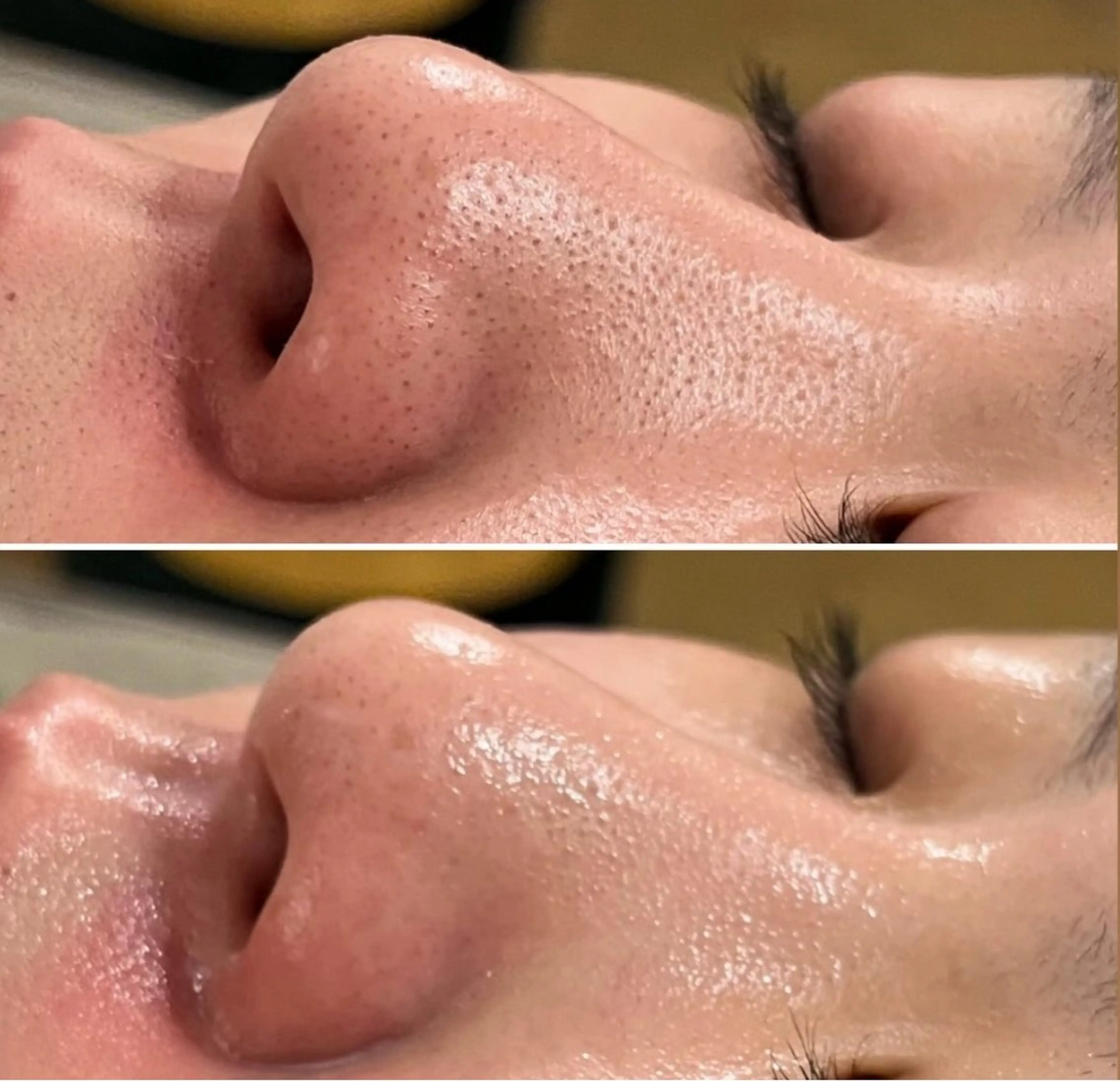 小顔・毛穴/ニキビ/ ハーブピーリング専門のエステ・リラクイメージ