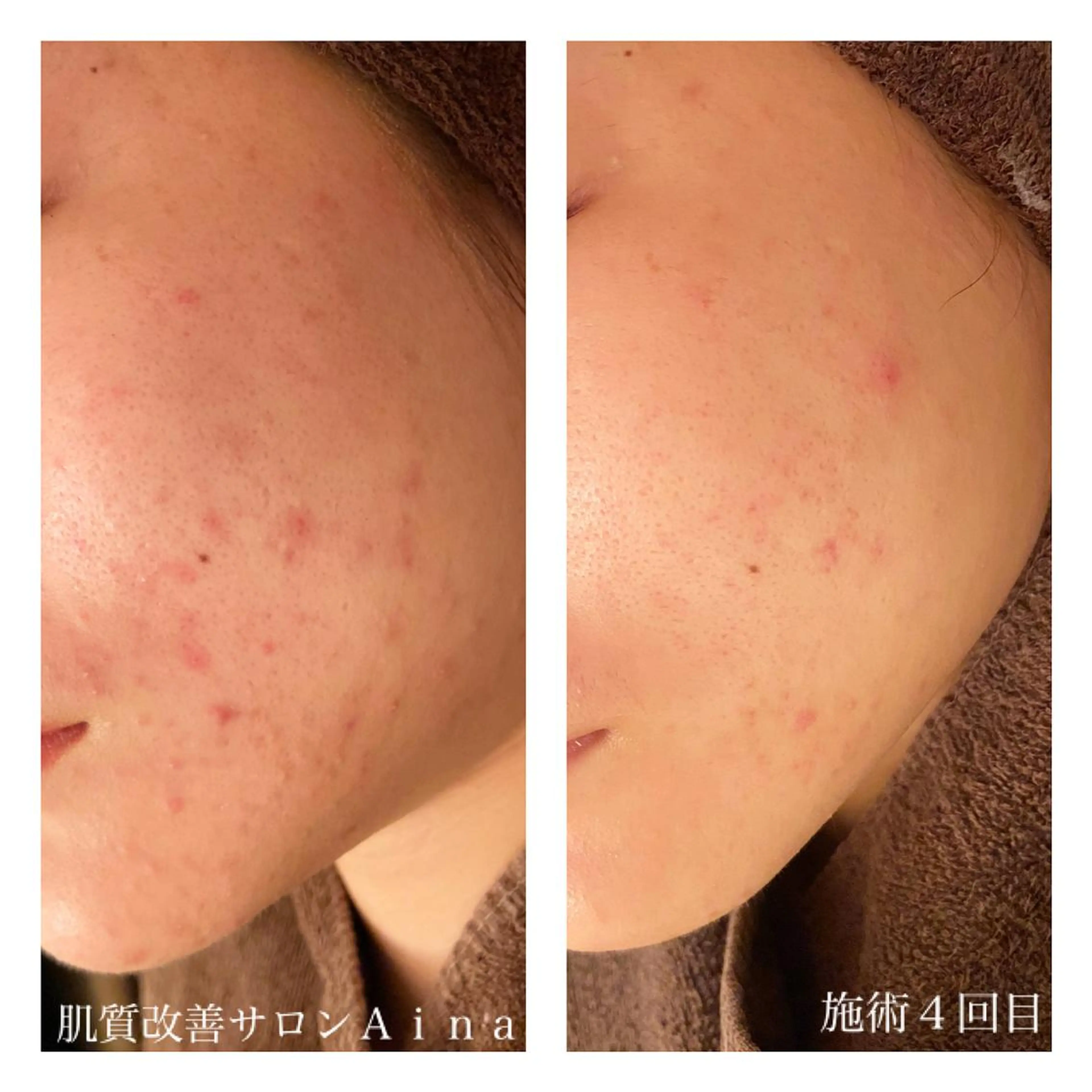 セミロング カラー パーマ ヘアアレンジ メンズ ネイル マツエク・マツパ 赤色 エステ リラク ニキビ跡専門サロン Ａｉｎａのエステ・リラクイメージ