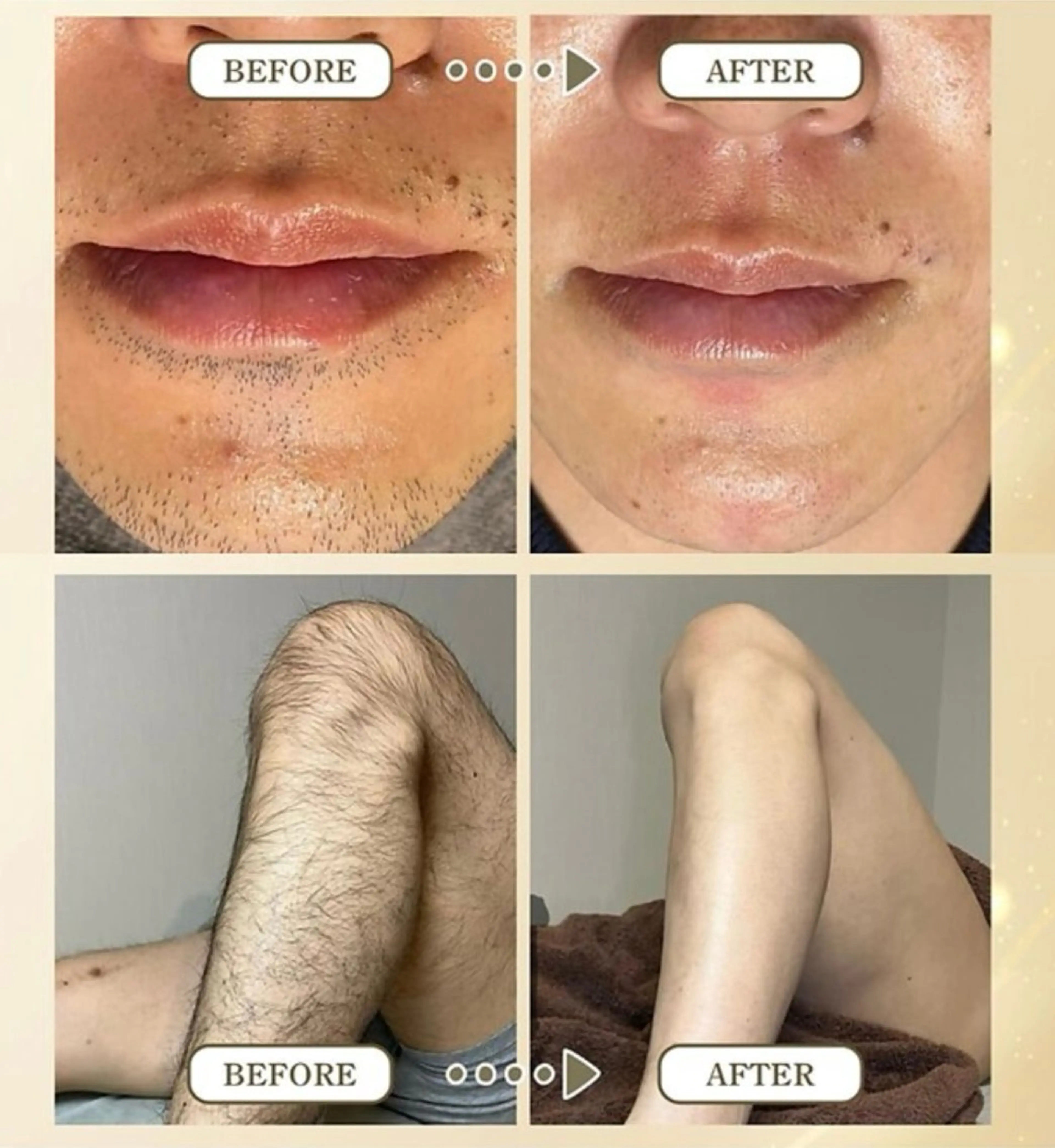 ヒゲ脱毛の写真