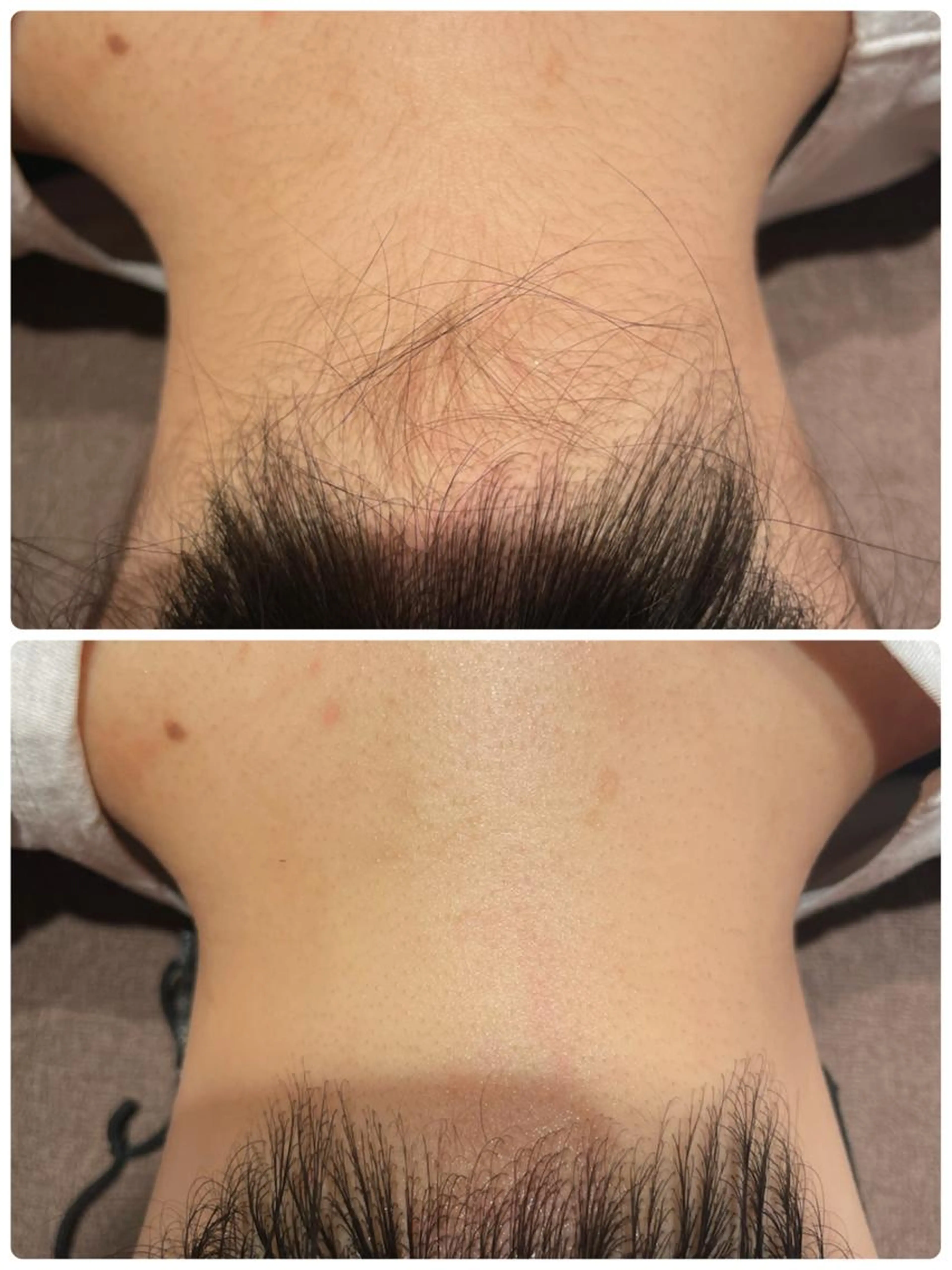 大人気♡うなじ脱毛3回パスの写真