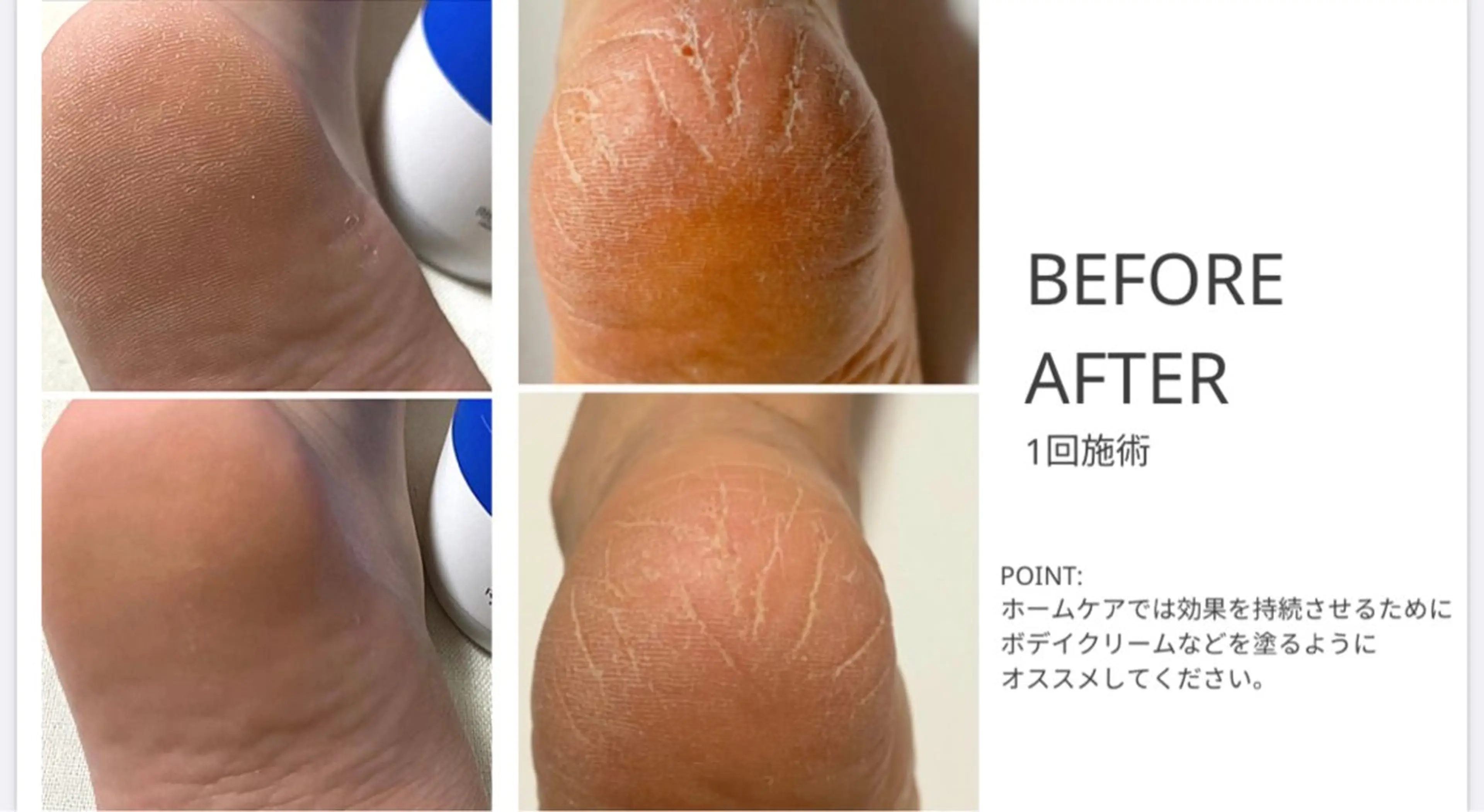 【🦶かかと】カーボキシーサロンケアの写真