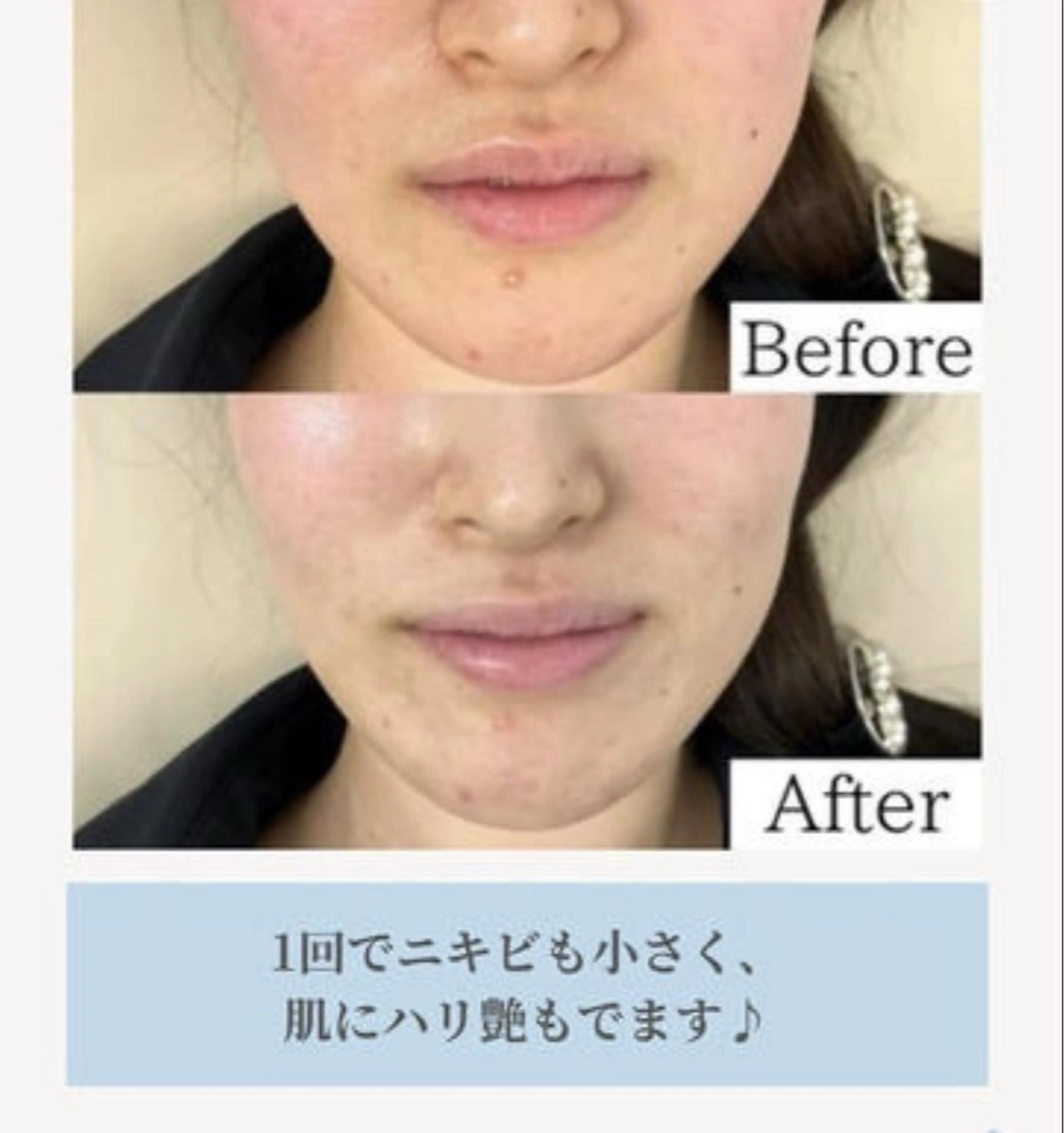 話題の乳酸ピーリング🧖🏻♀️🌝✨の写真