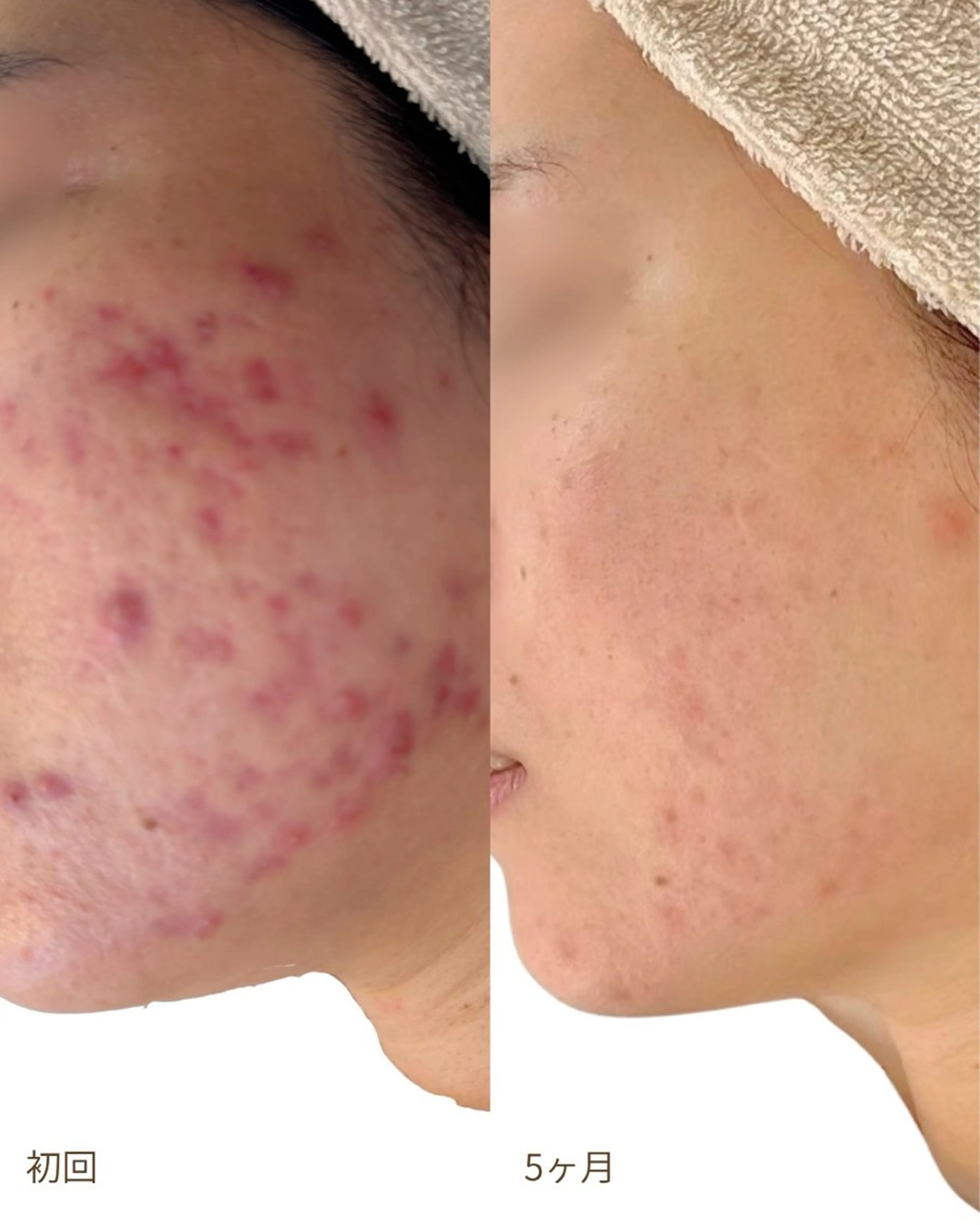 エステ Nicore所属・肌質改善🌿まつ毛 chapiのその他イメージ