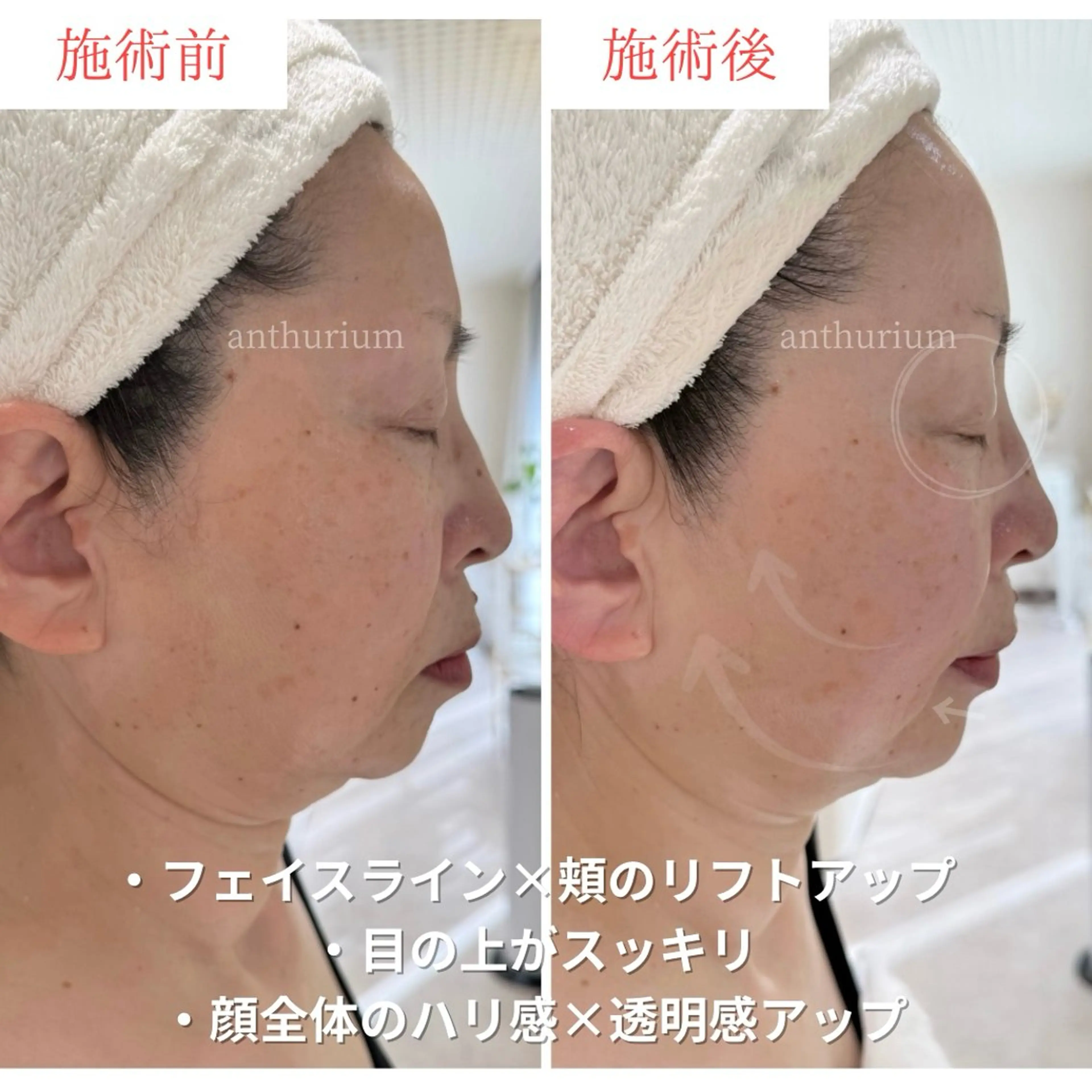 卒業式・入学式前限定🌸写真に残る“ママのためのリフトアップケア”の写真