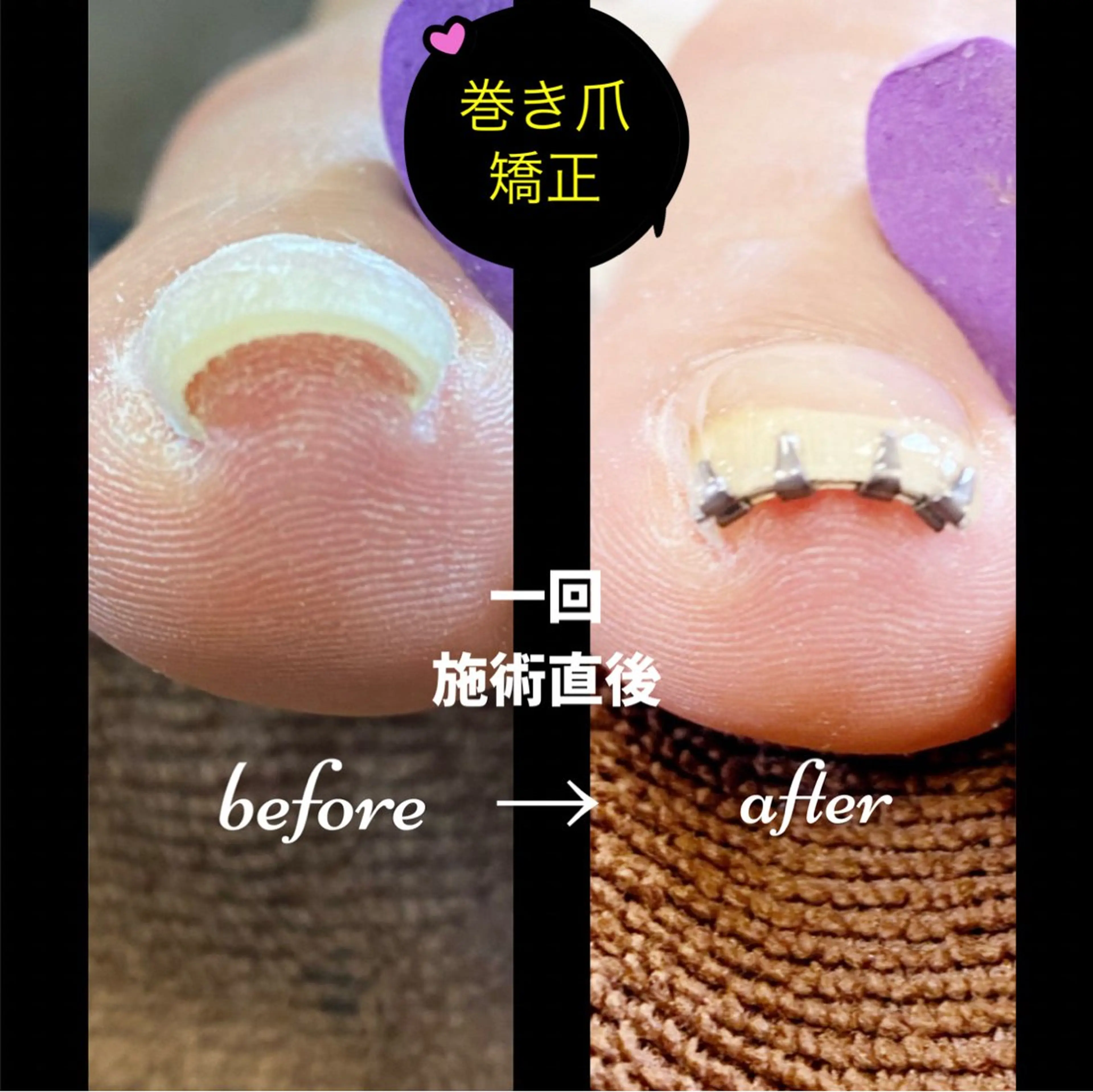 ネイル フットネイル ネイル＆脱毛 Lotus🌸のネイルデザイン