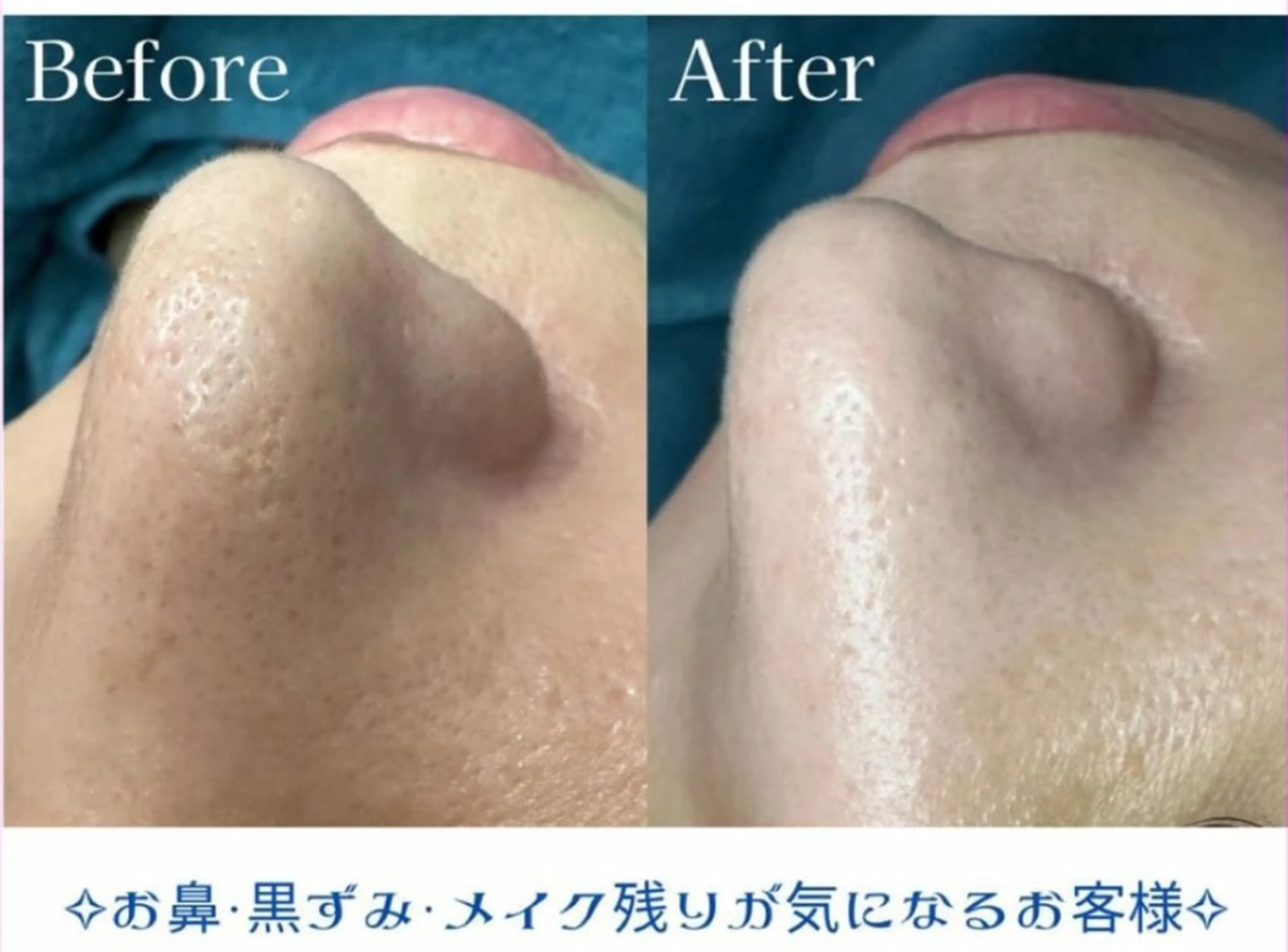 エイジングケアサロンBIOEL所属・肌質改善BIOELプ ラズマ/ラミピールのエステ・リラクイメージ