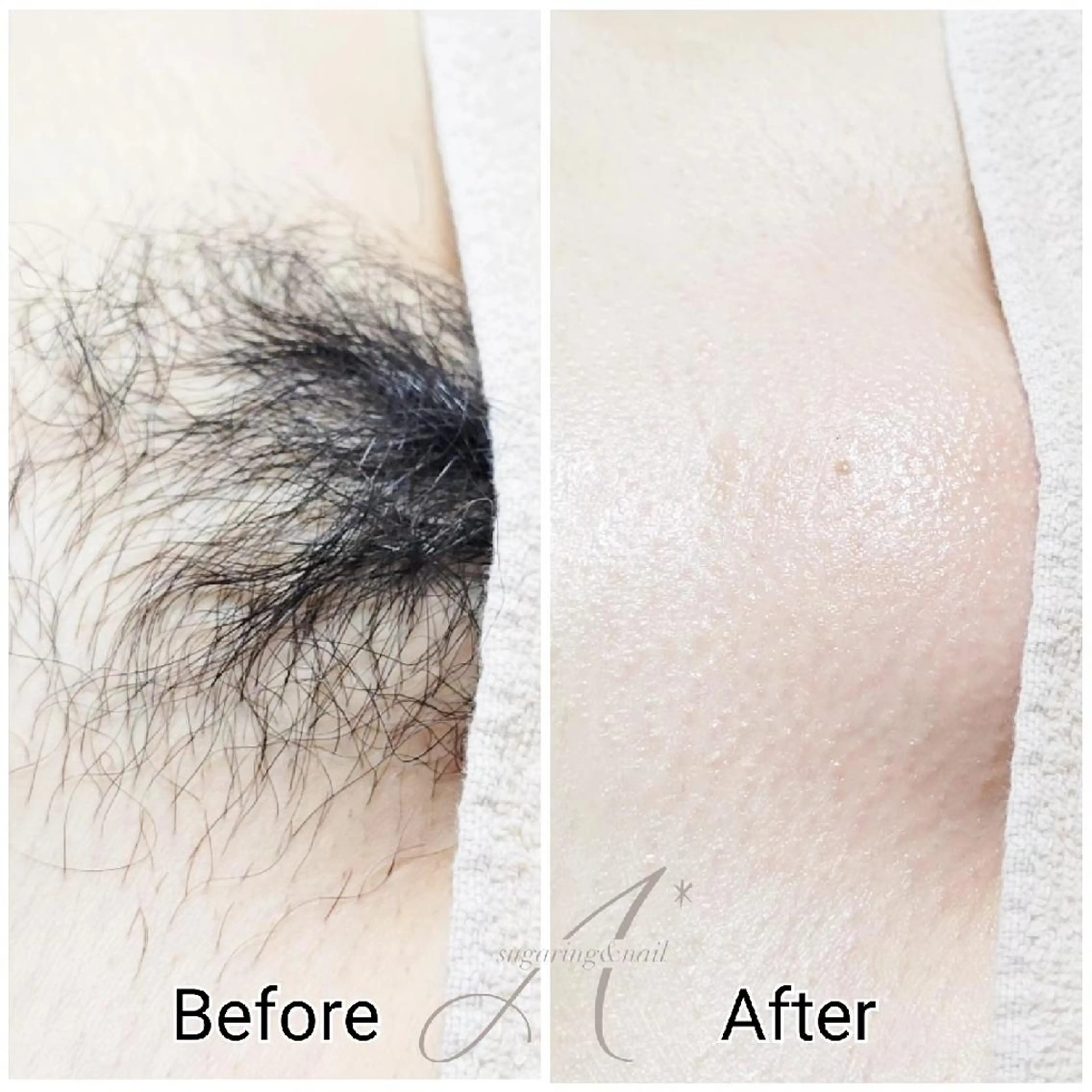 都度払い🍋VIOシュガーリング+全身最新光脱毛の写真