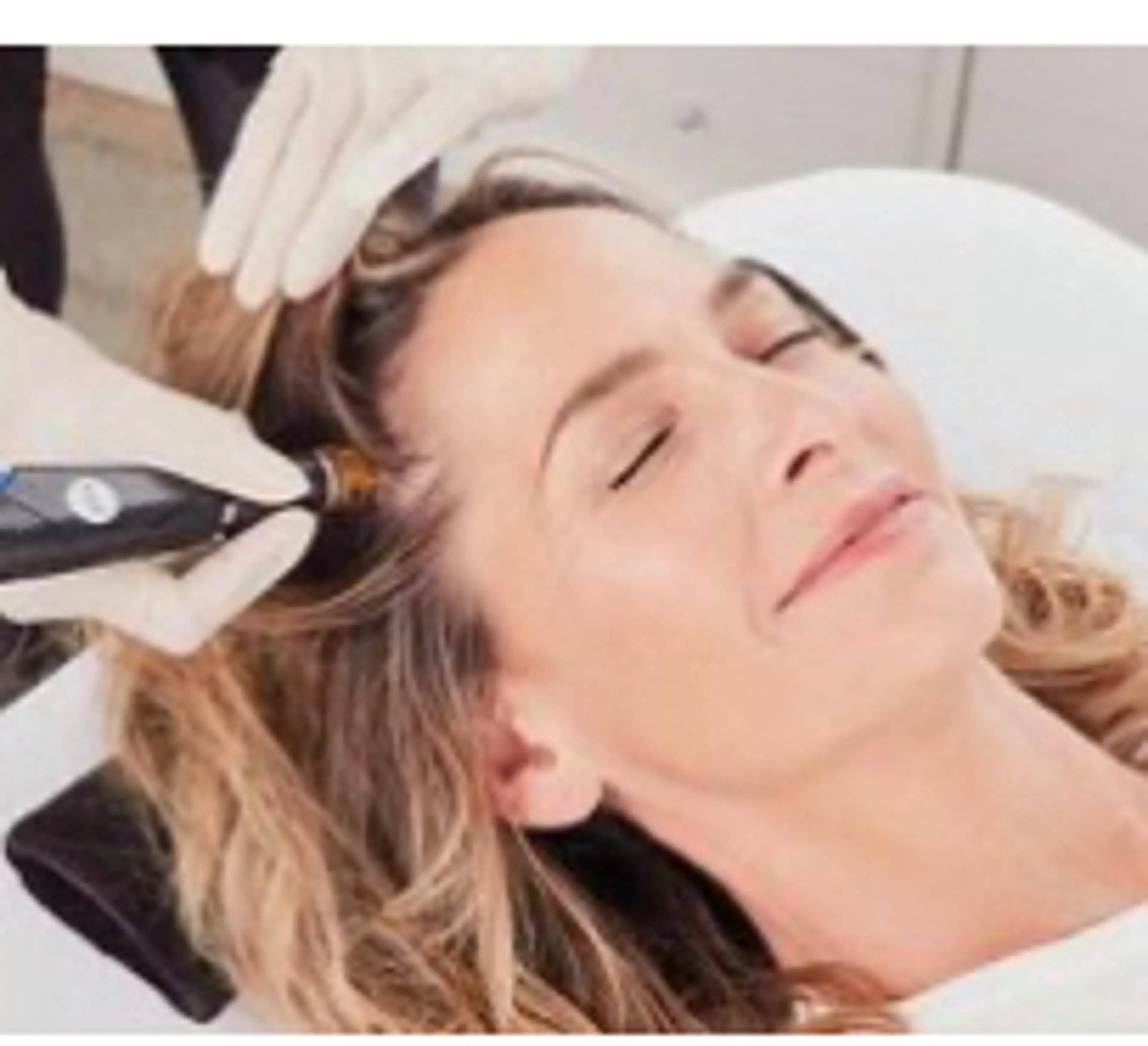 頭皮ケア 育毛の促進　頭皮ハイドラ 毛穴洗浄 ドライヘッドスパ付きの写真