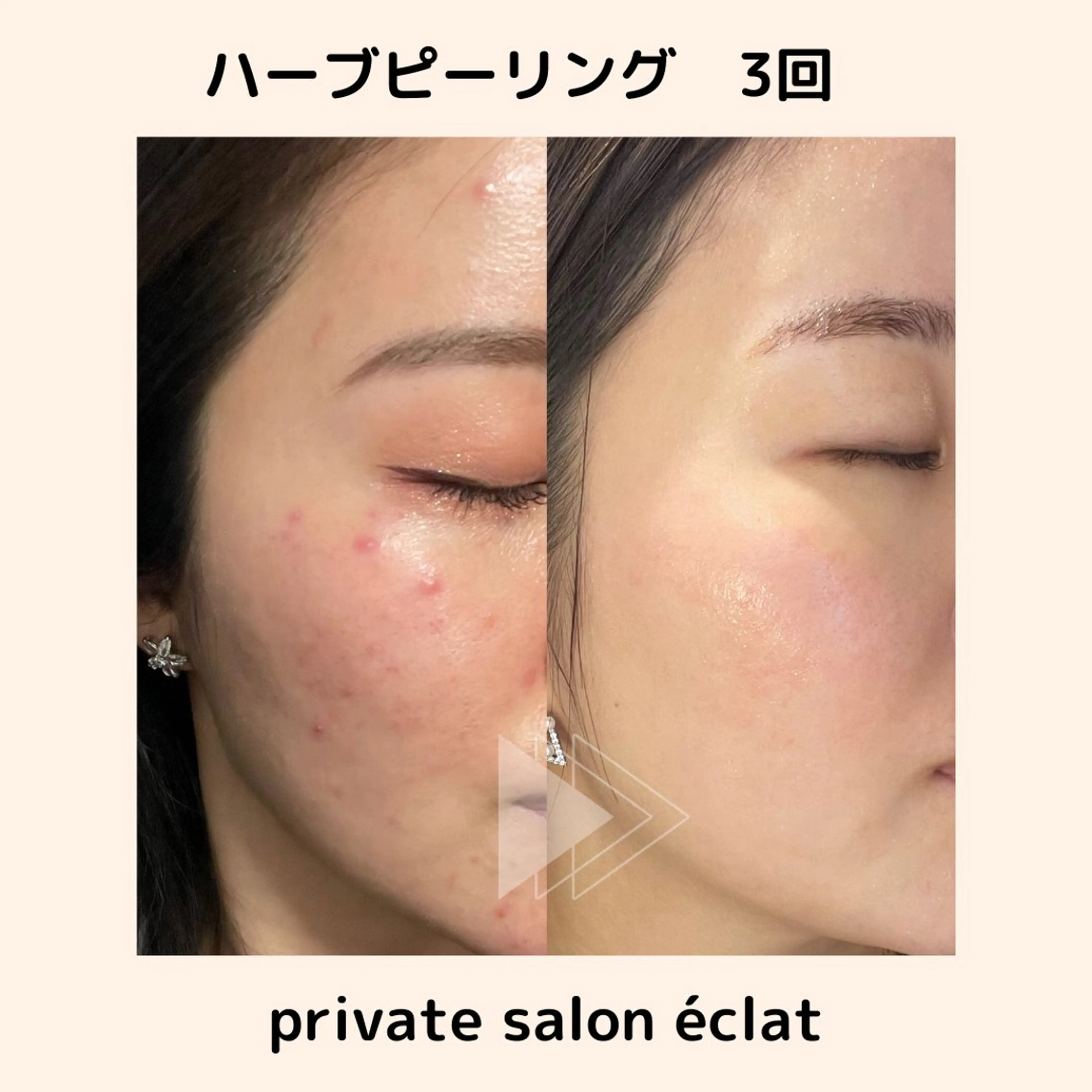 private salon éclat所属・ニキビ・毛穴専門 éclat/エクラのエステ・リラクイメージ