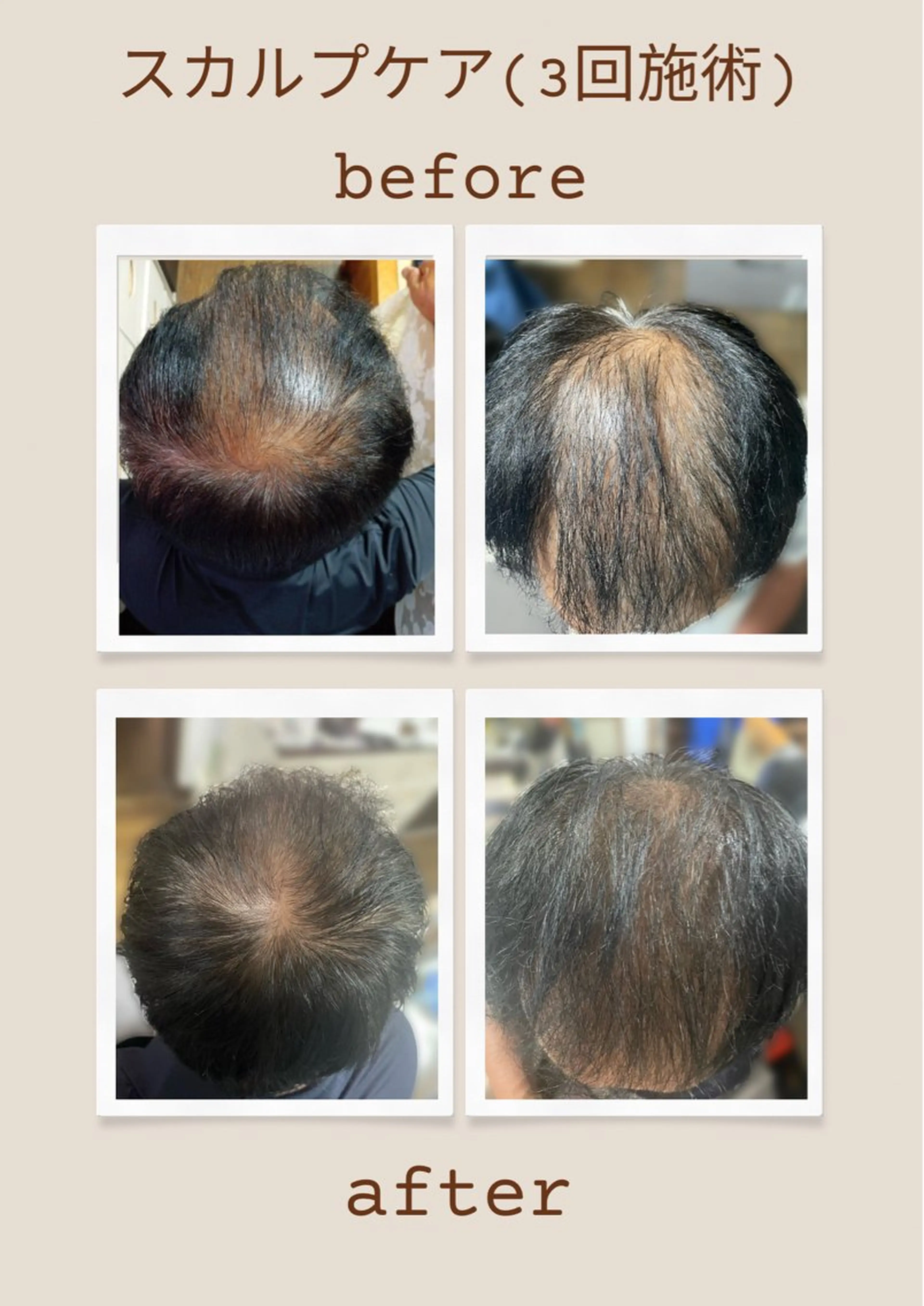 スカルプケア(育毛促進)✨️炭酸ヘッドマッサージ              毛根状態で個人差があります🙇🏻‍♀️の写真