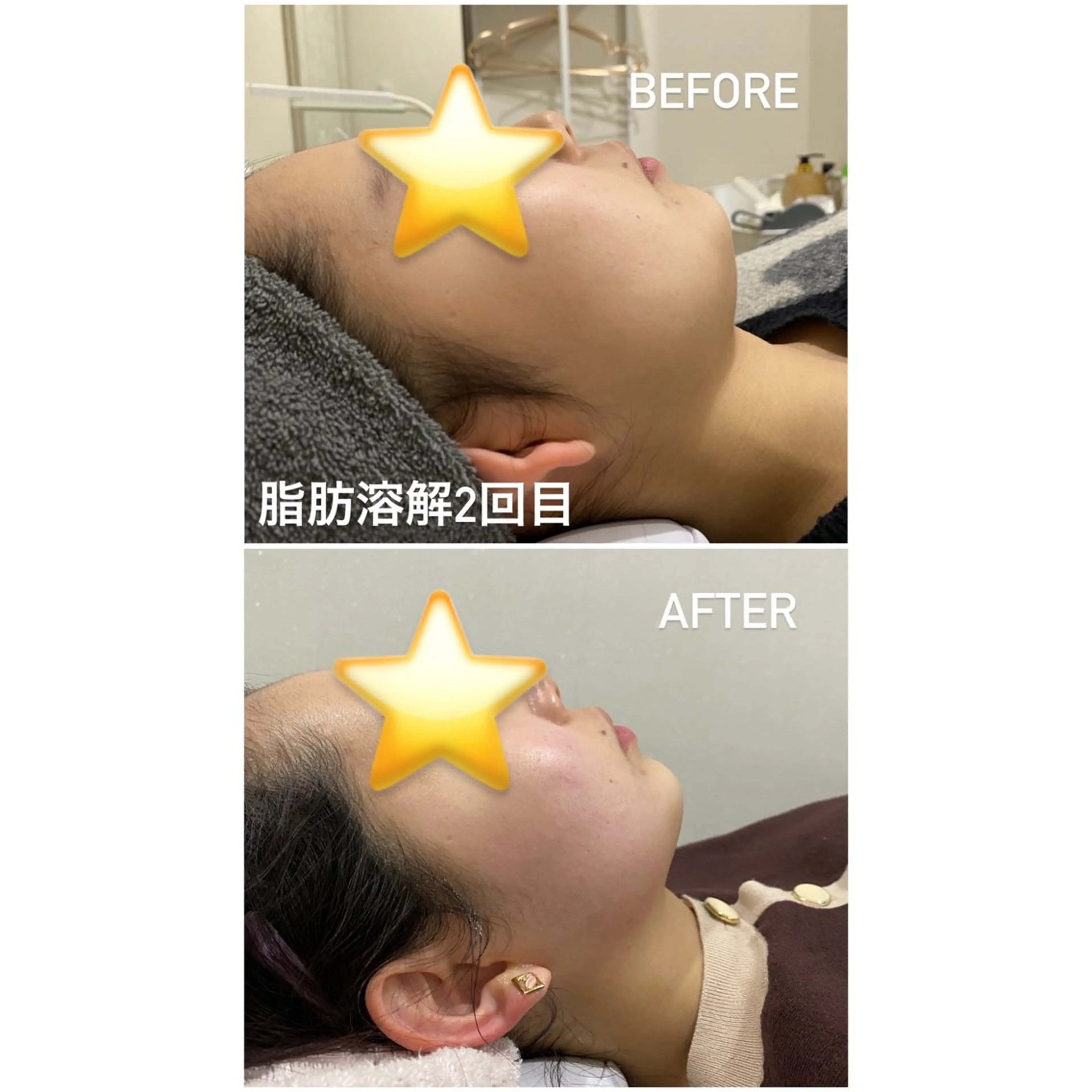 【男女】脂肪除去　顔（5ml）1ヶ月通い放題✨の写真
