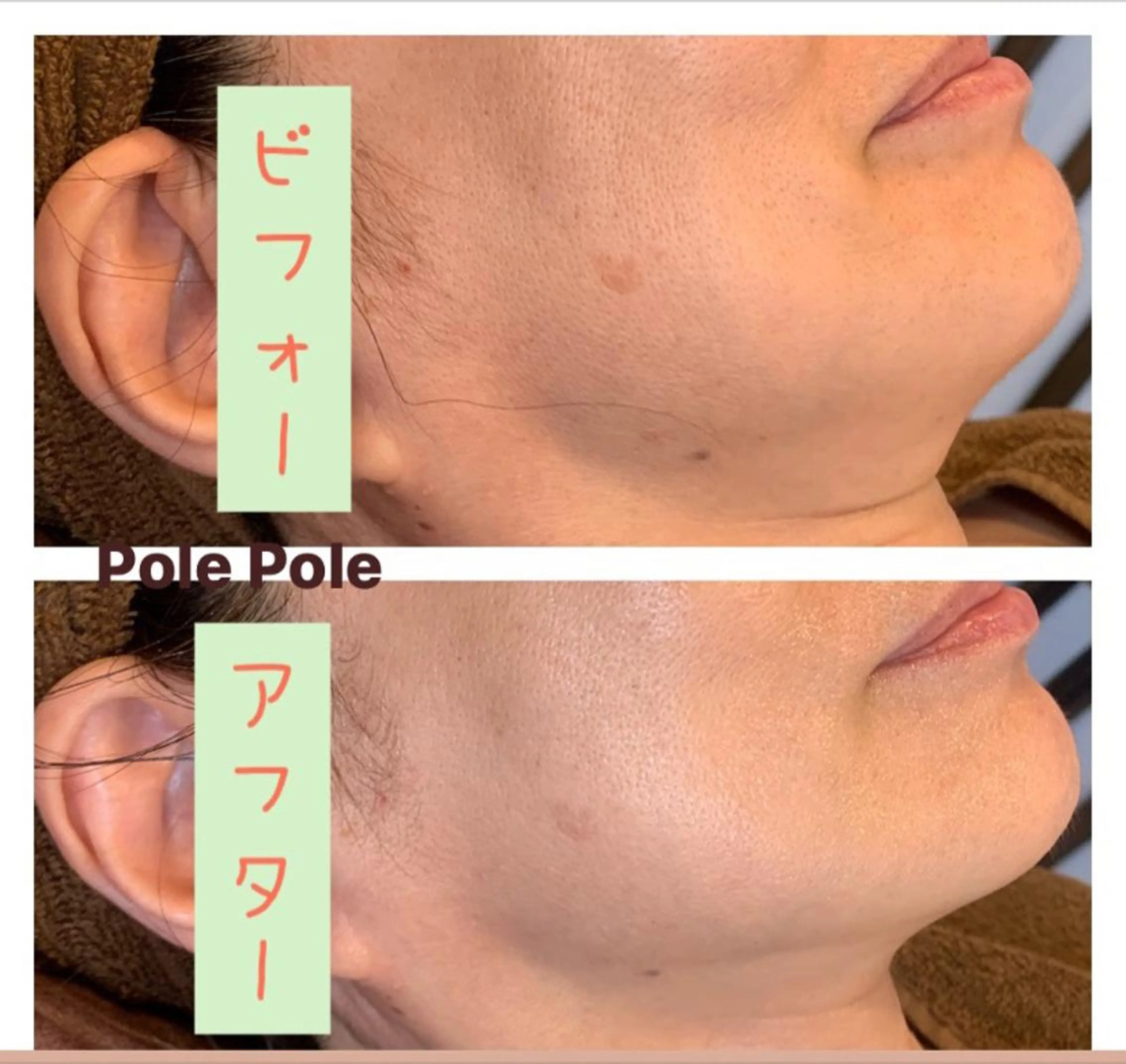 保湿コース（フェイシャル）の写真