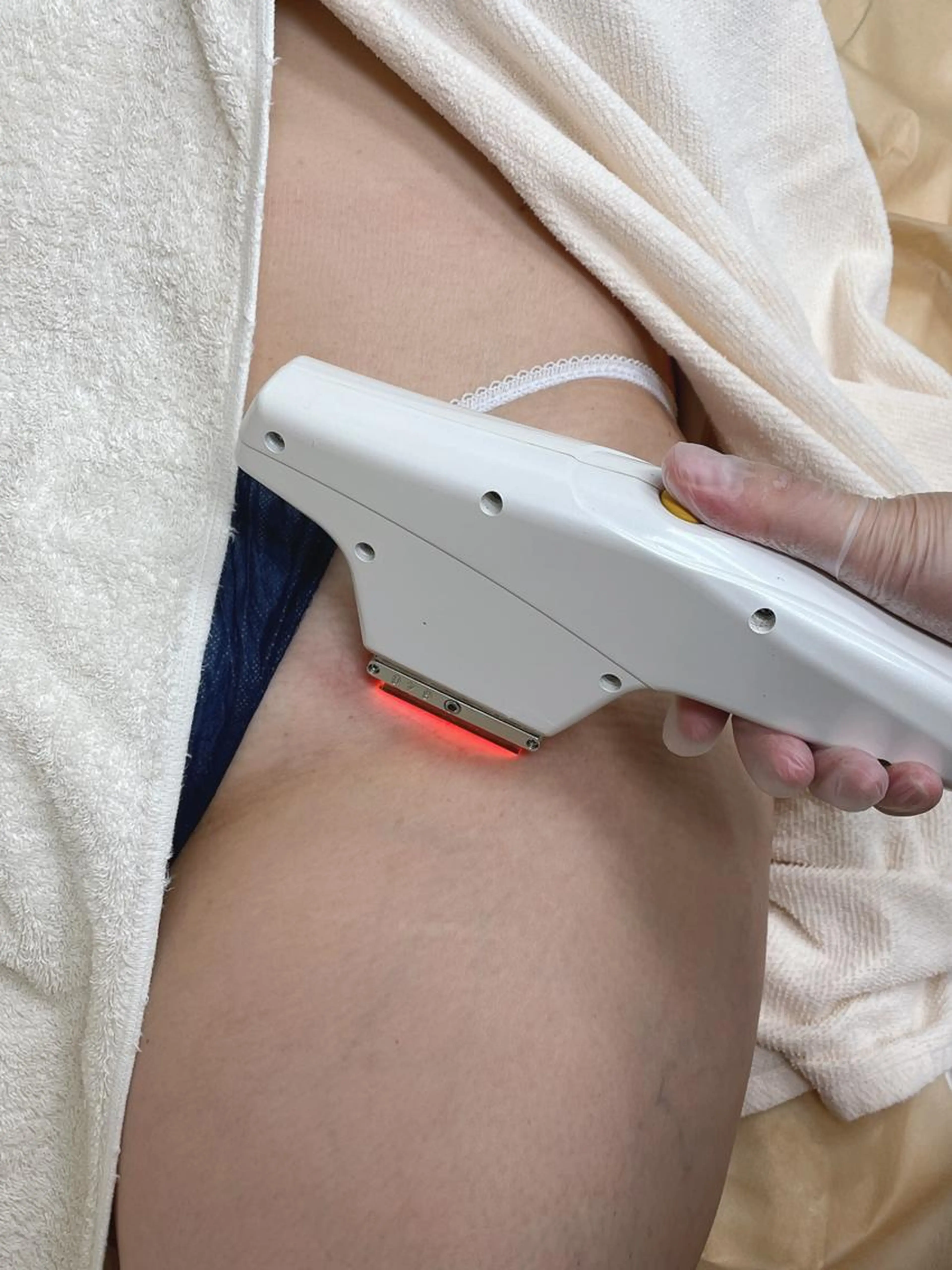 【平日限定】【IPL脱毛】　VIO脱毛の写真