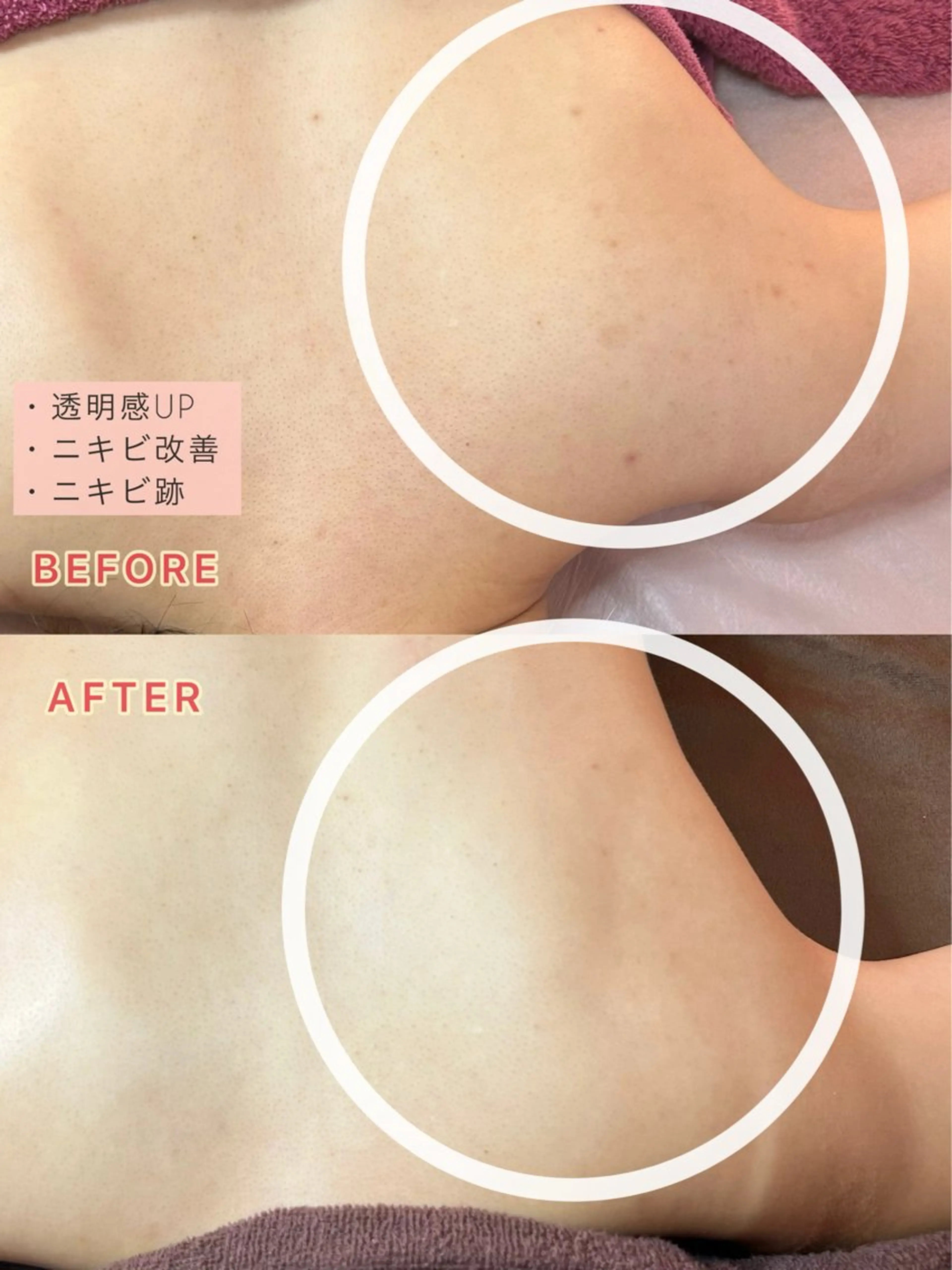 【背中orお尻ケア】背中ニキビやお尻ニキビ、ざらつきケアにの写真