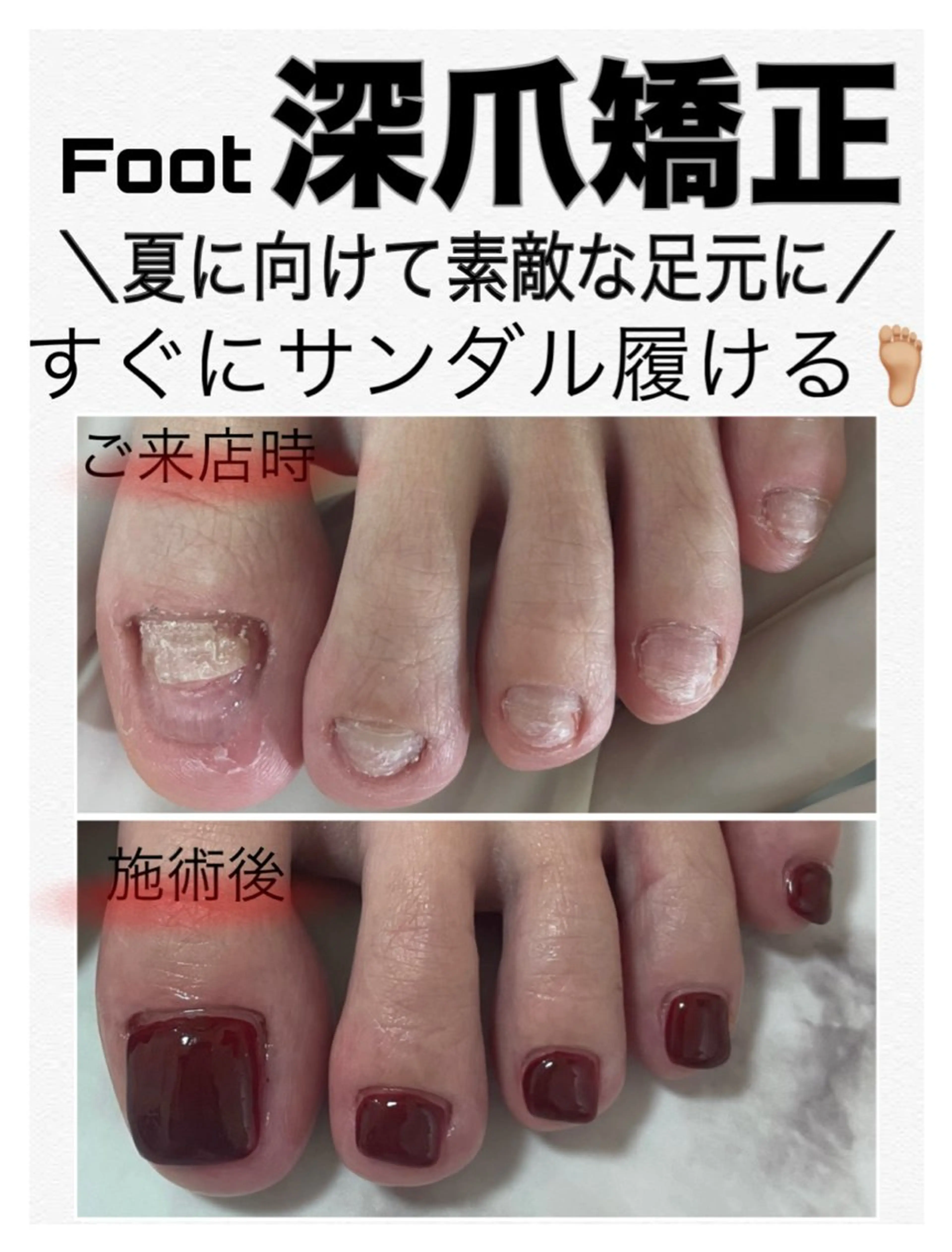 フット深爪矯正【長さ出し】◆ワンカラー◆(オフ込/フットバス付) むしったり 割れたり 小さくなった爪も綺麗な状態に✧︎の写真
