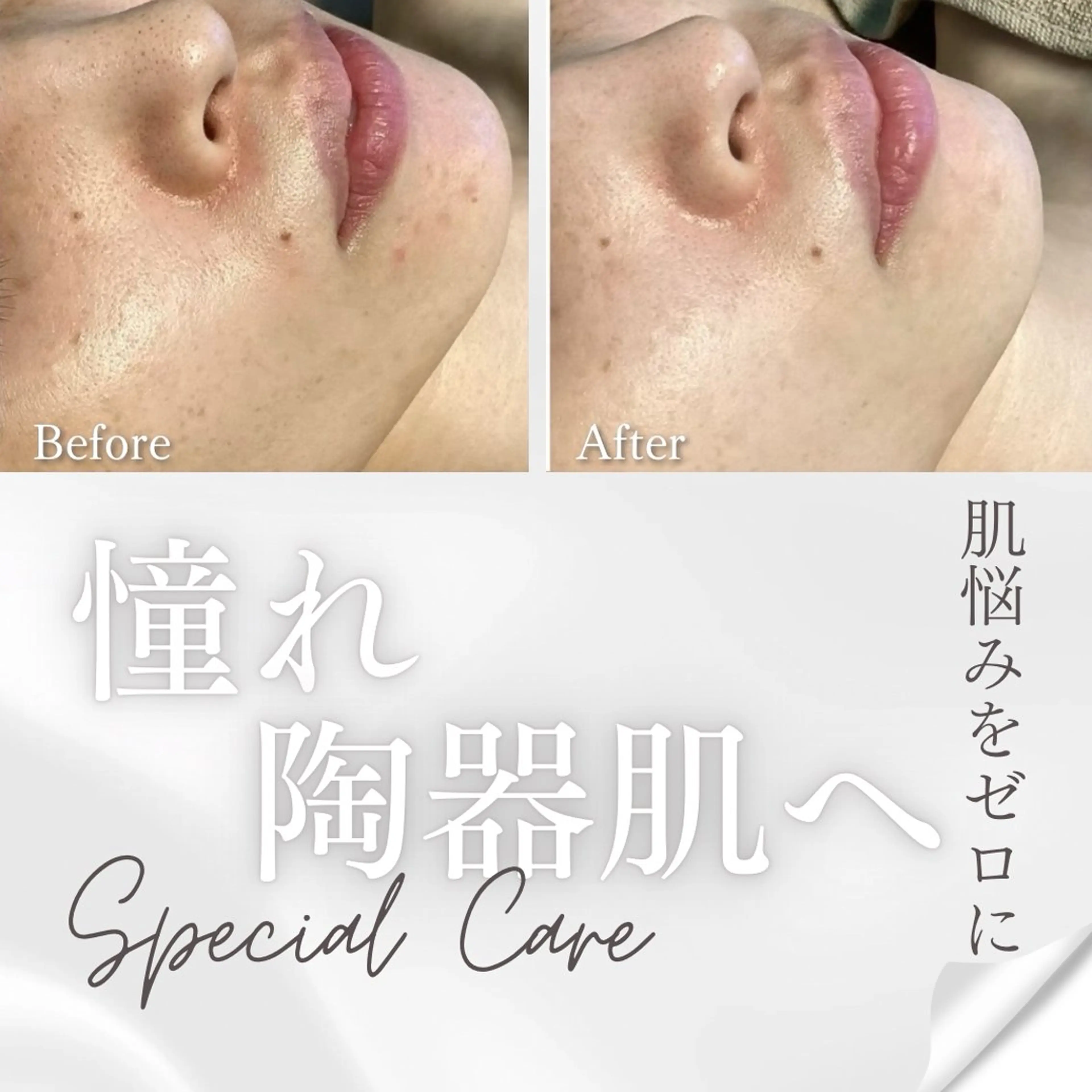 大人気国産🇯🇵ハーブピーリング＋小顔ソフトコルギ🌿✨の写真