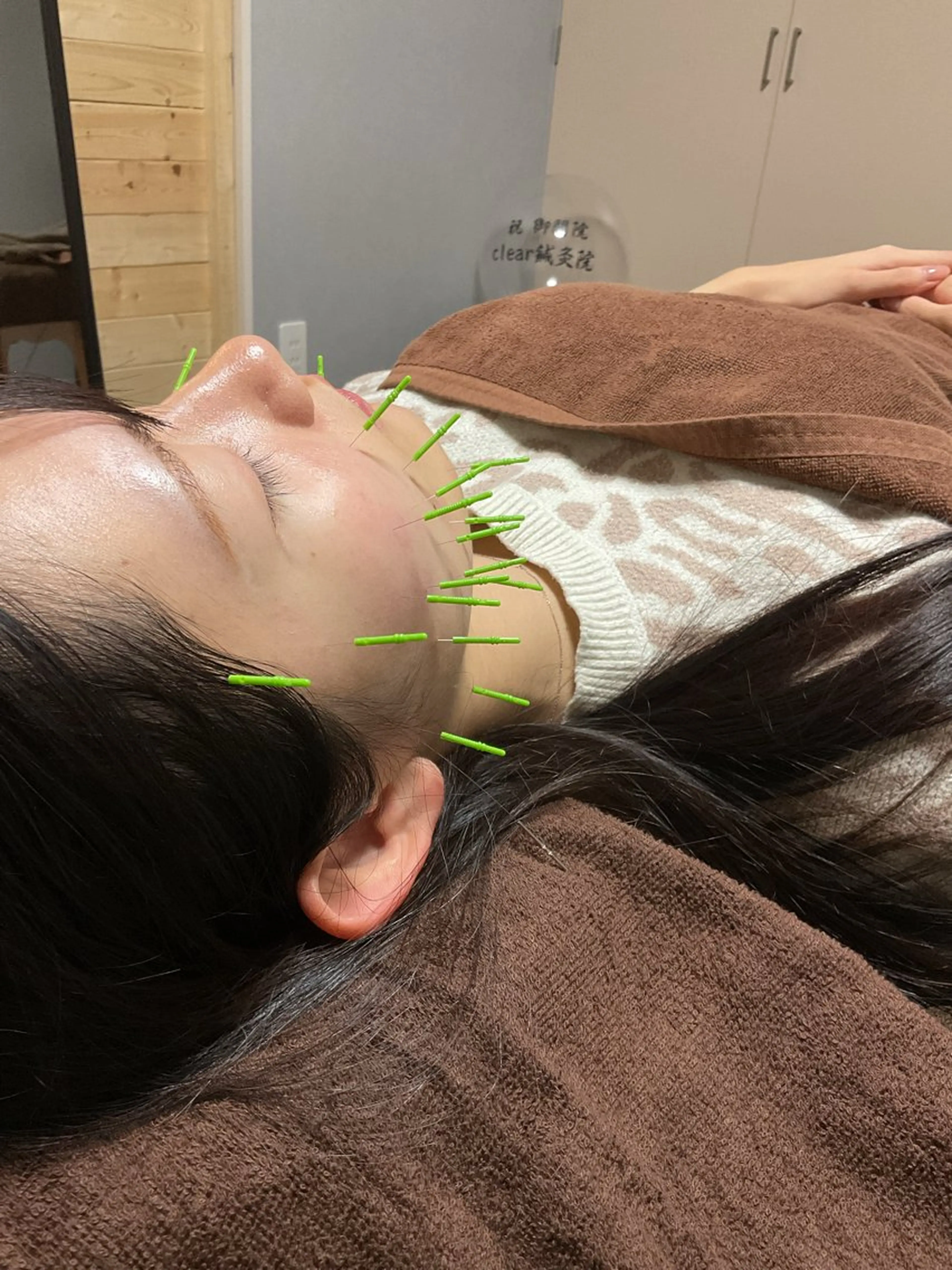 美容鍼🪡の写真