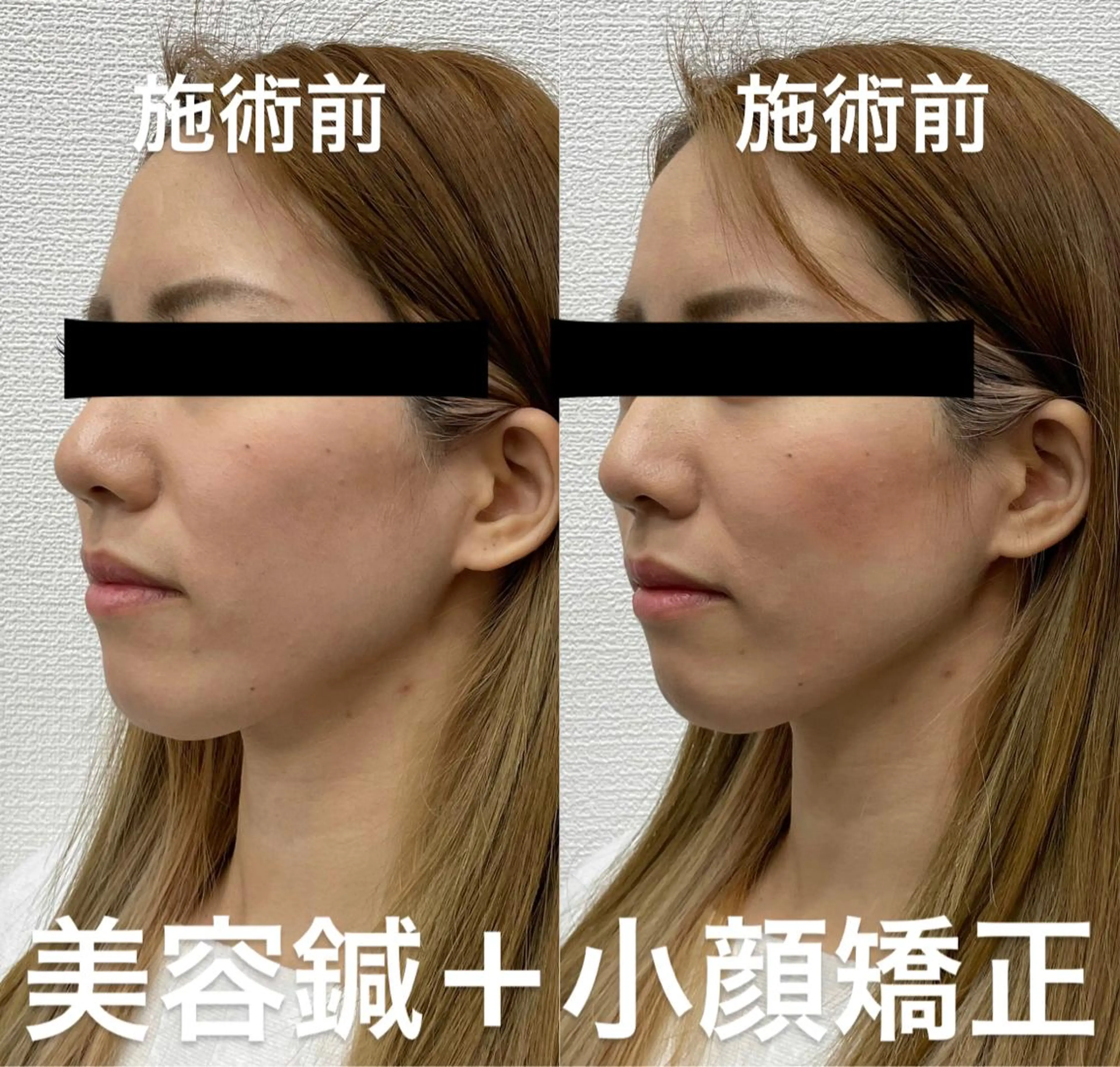 その他 つばさ所属・マッツンの 鍼のその他イメージ