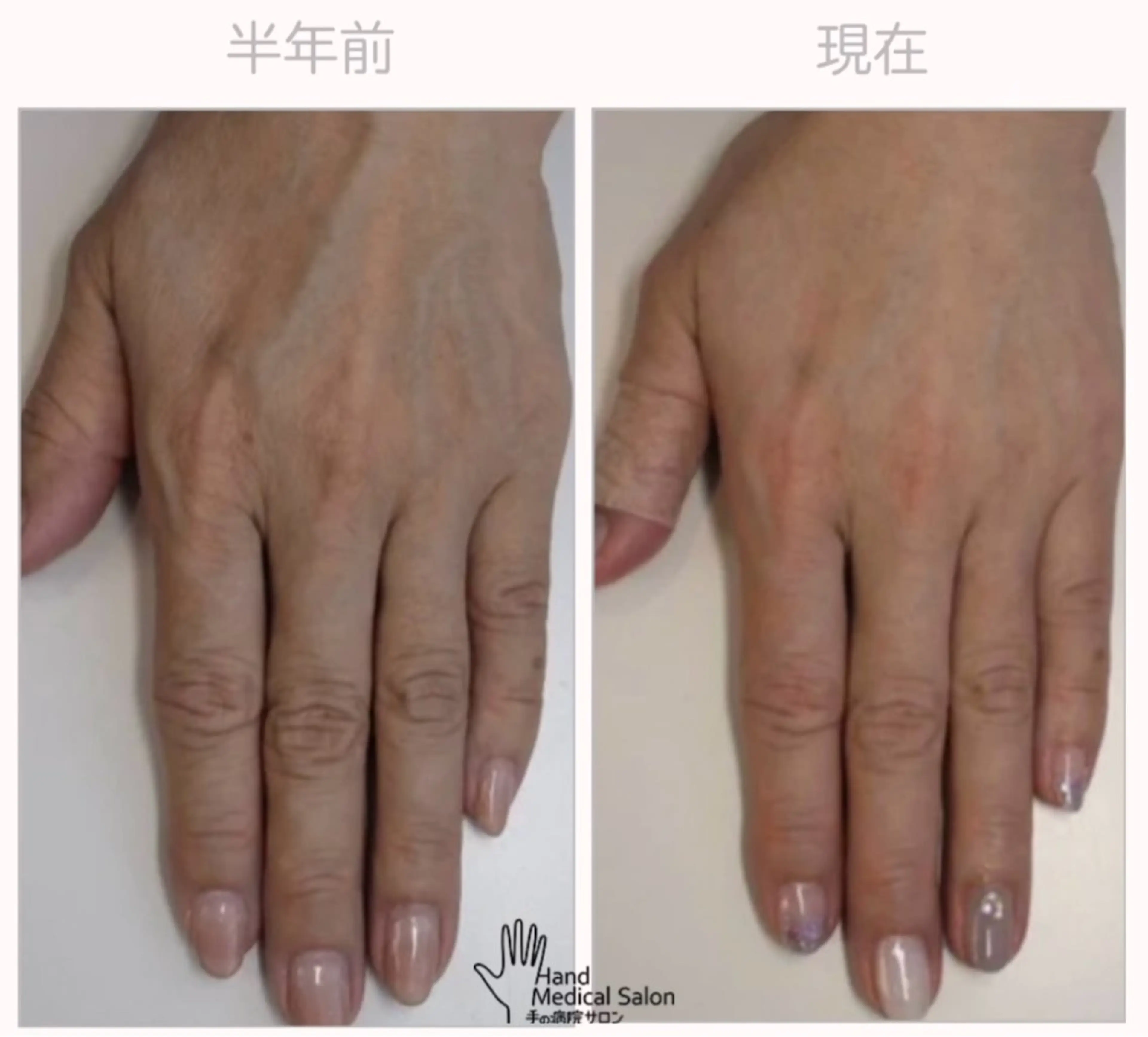 ネイル ハンドケア 自爪育成専門サロンbelltiffy所属・オーナーネイリスト 宮添華里のネイルデザイン