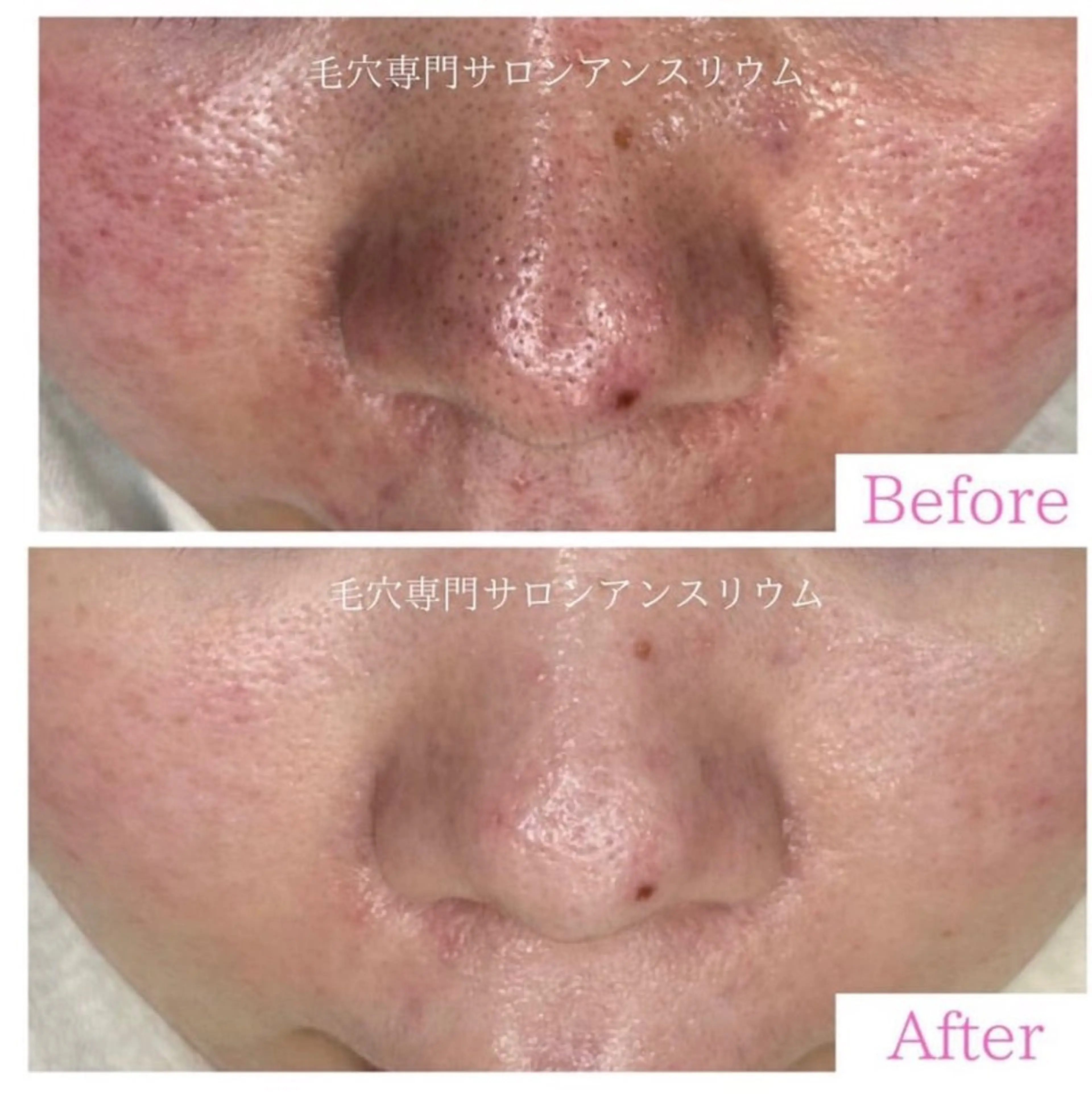 毛穴ケア専門サロンアンスリウム所属・茨城土浦 つくば毛穴 ケア専門サロンのエステ・リラクイメージ