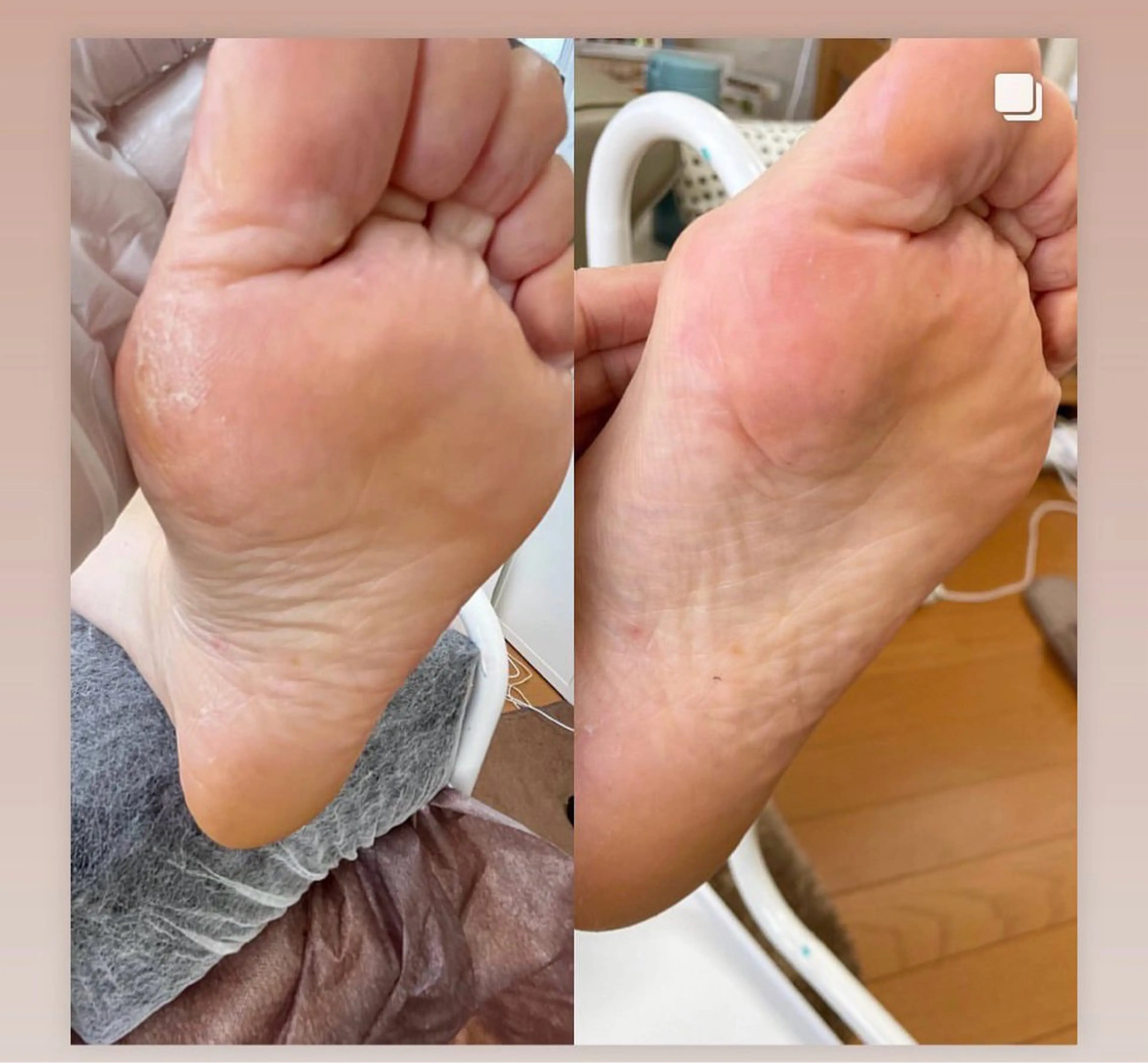 角質ケアの写真