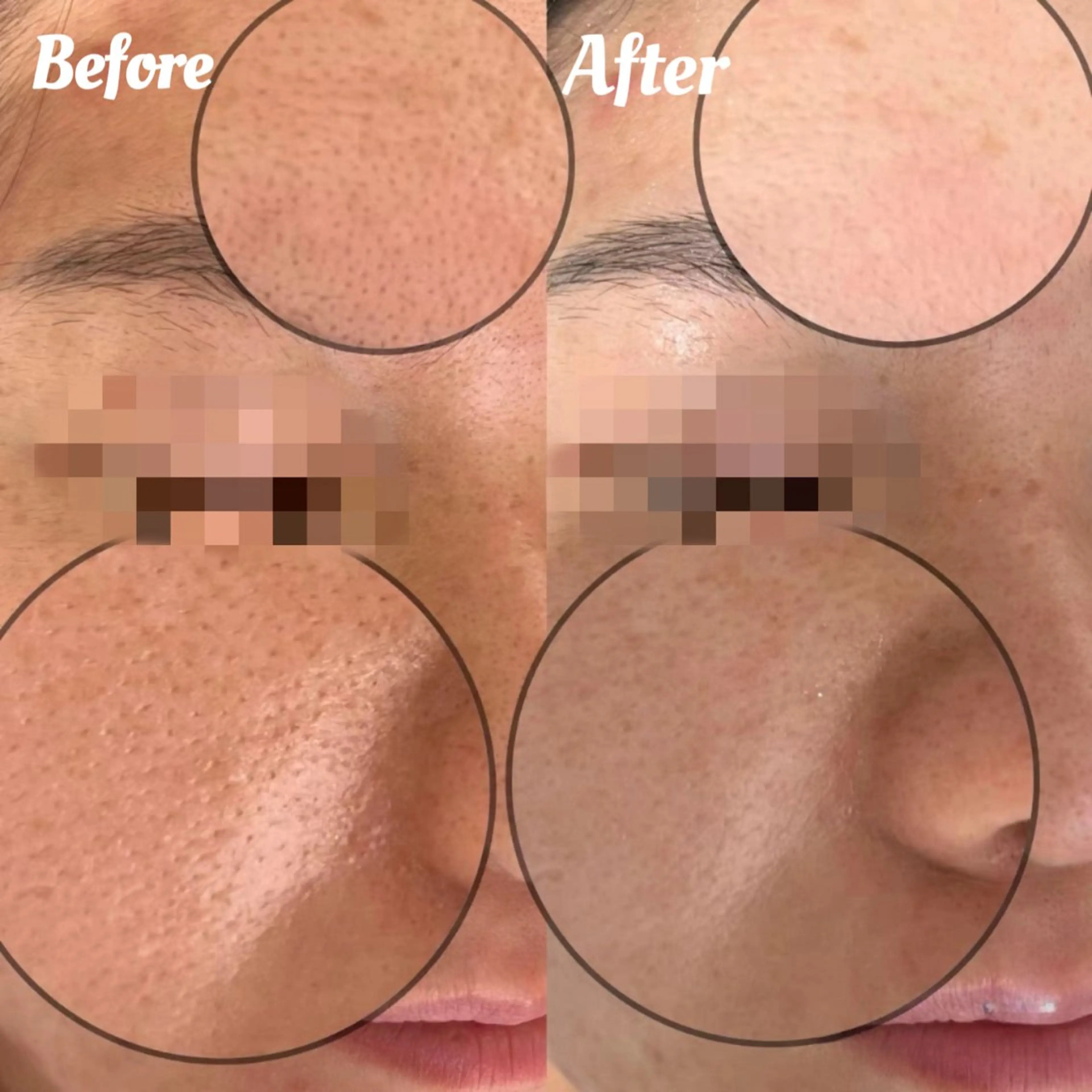 ☆美容皮膚科をサ口ン価額で実現☆シミケア小顔☆最新IPL光フエシャル&毛穴洗浄+デコルテ+イオン導入の写真