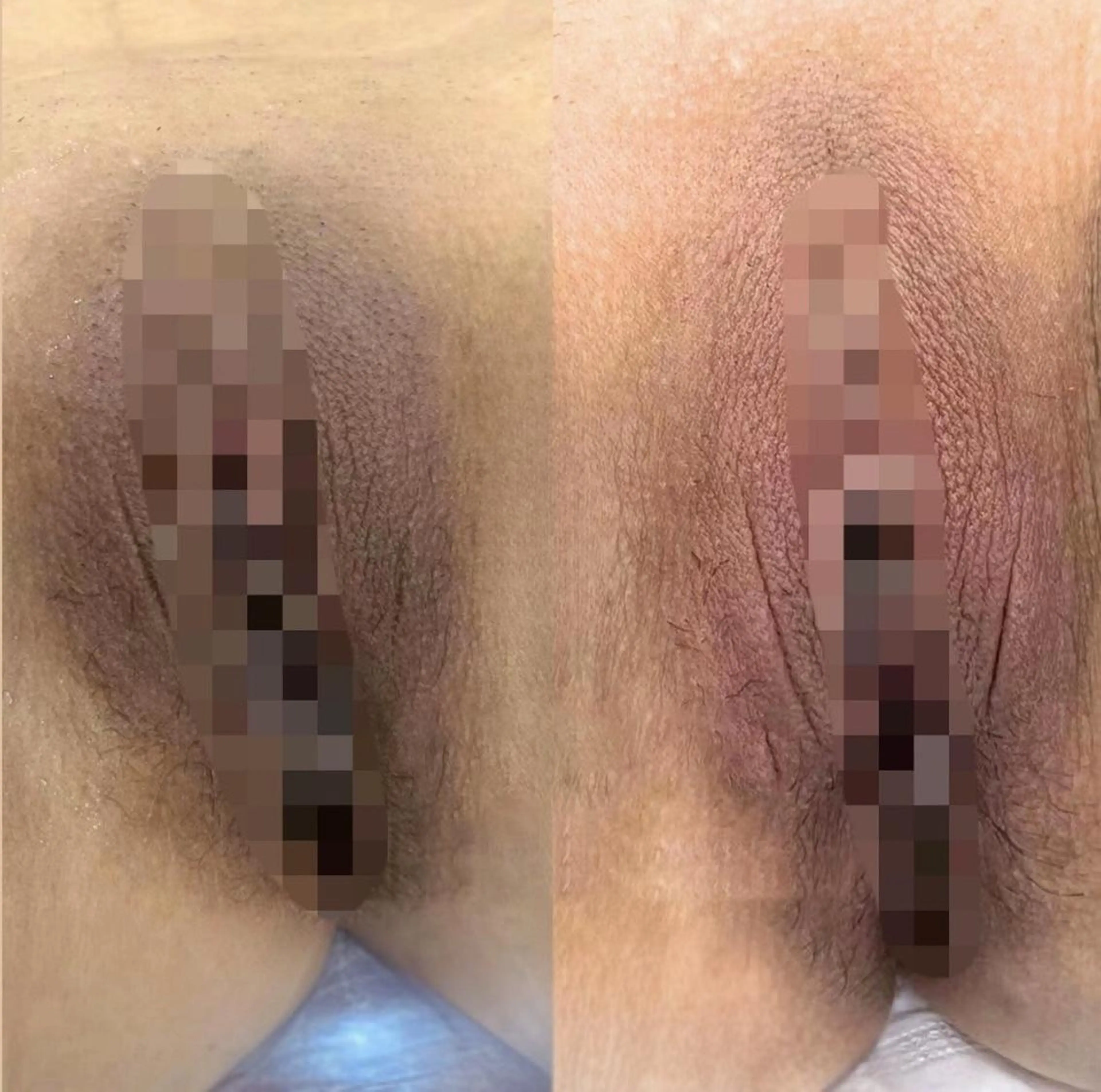 【最先端韓国式メラニンケア】ドールピンク《Iライン》￥55,000の写真