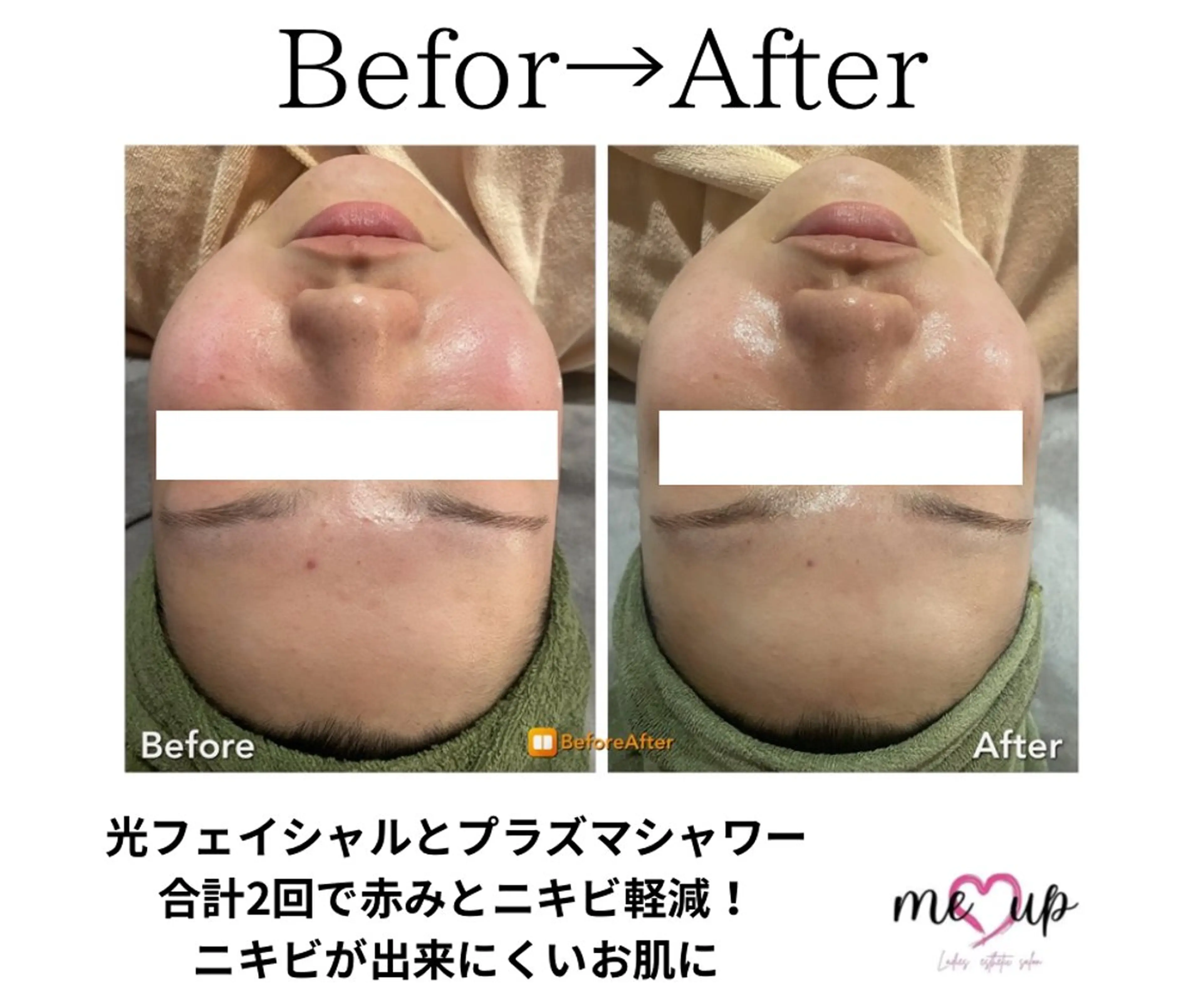 エステ Meupニキビ専門店 背中/ハーブ/肌管理のその他イメージ