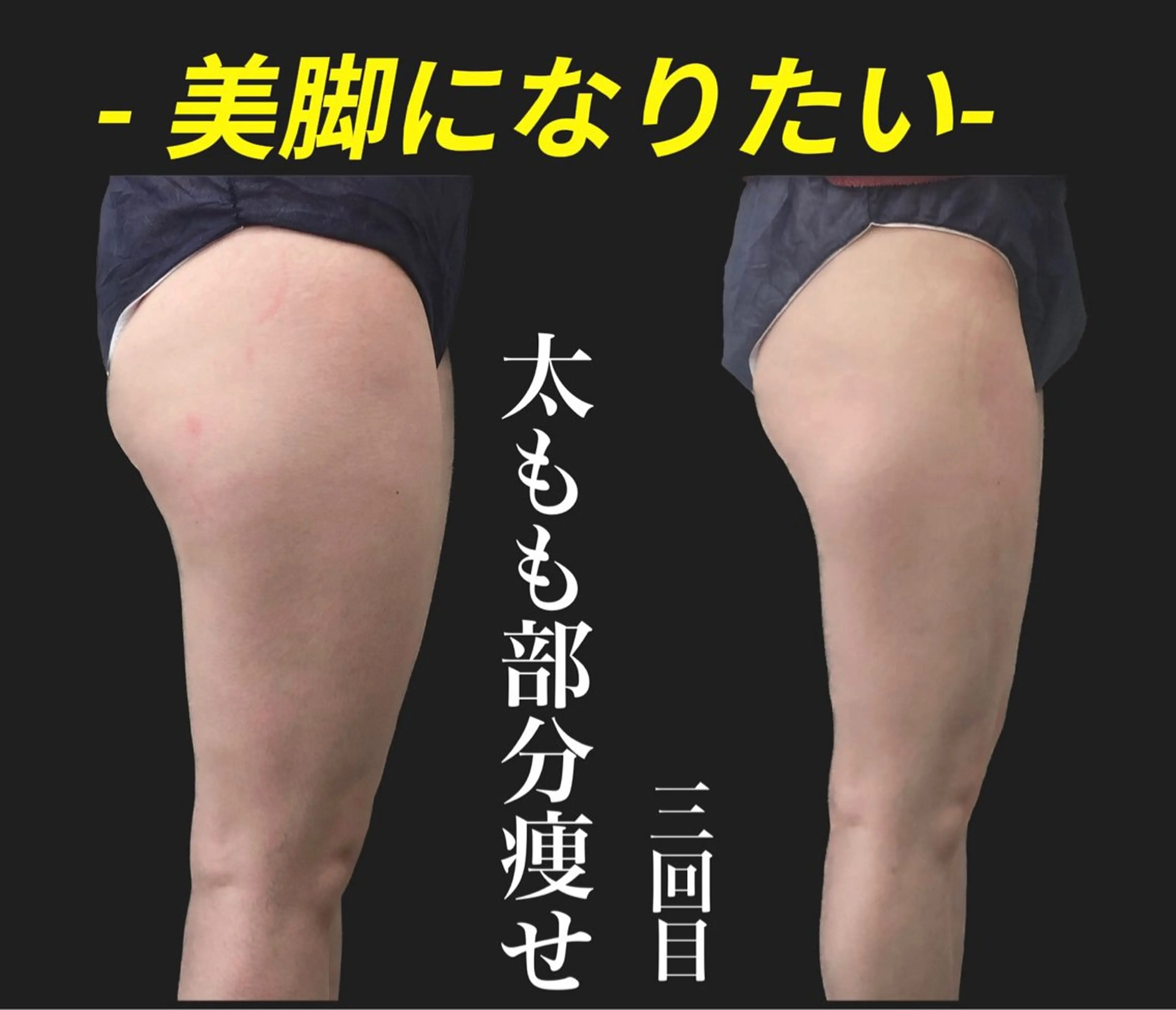 下半身サイズダウン⭐️夏に向け🦵徹底‼️筋膜脂肪アプローチの写真