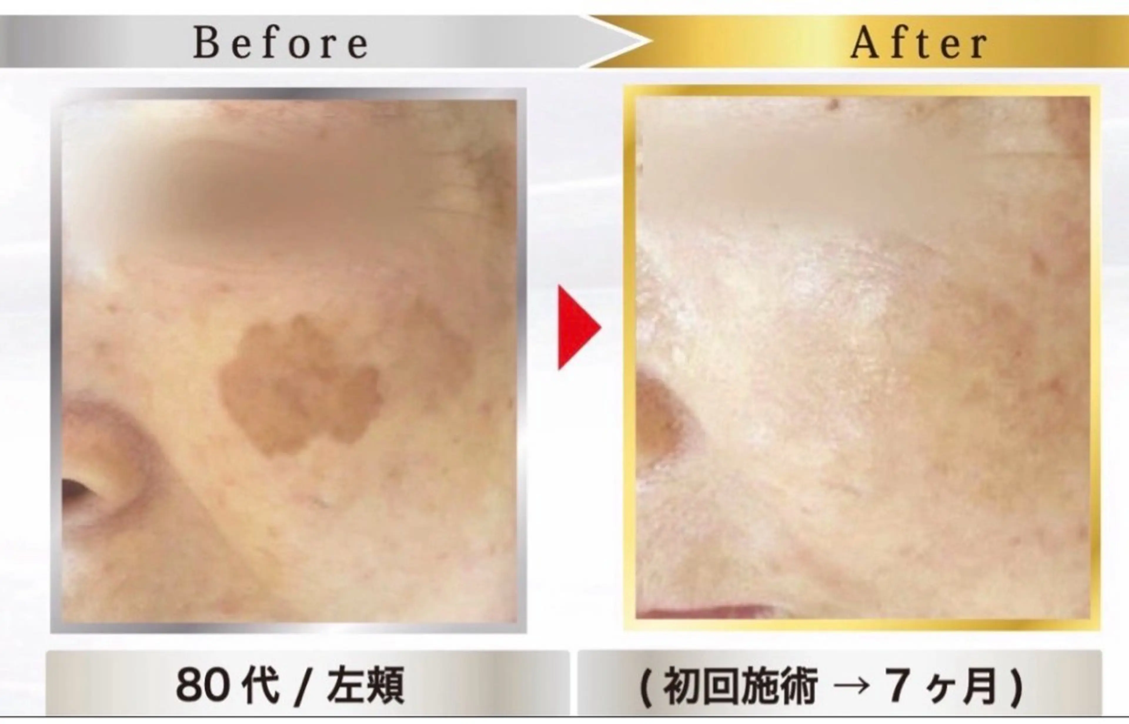 地域No.1👑本気のシミケア放題✨デコルテマッサージ付きの写真