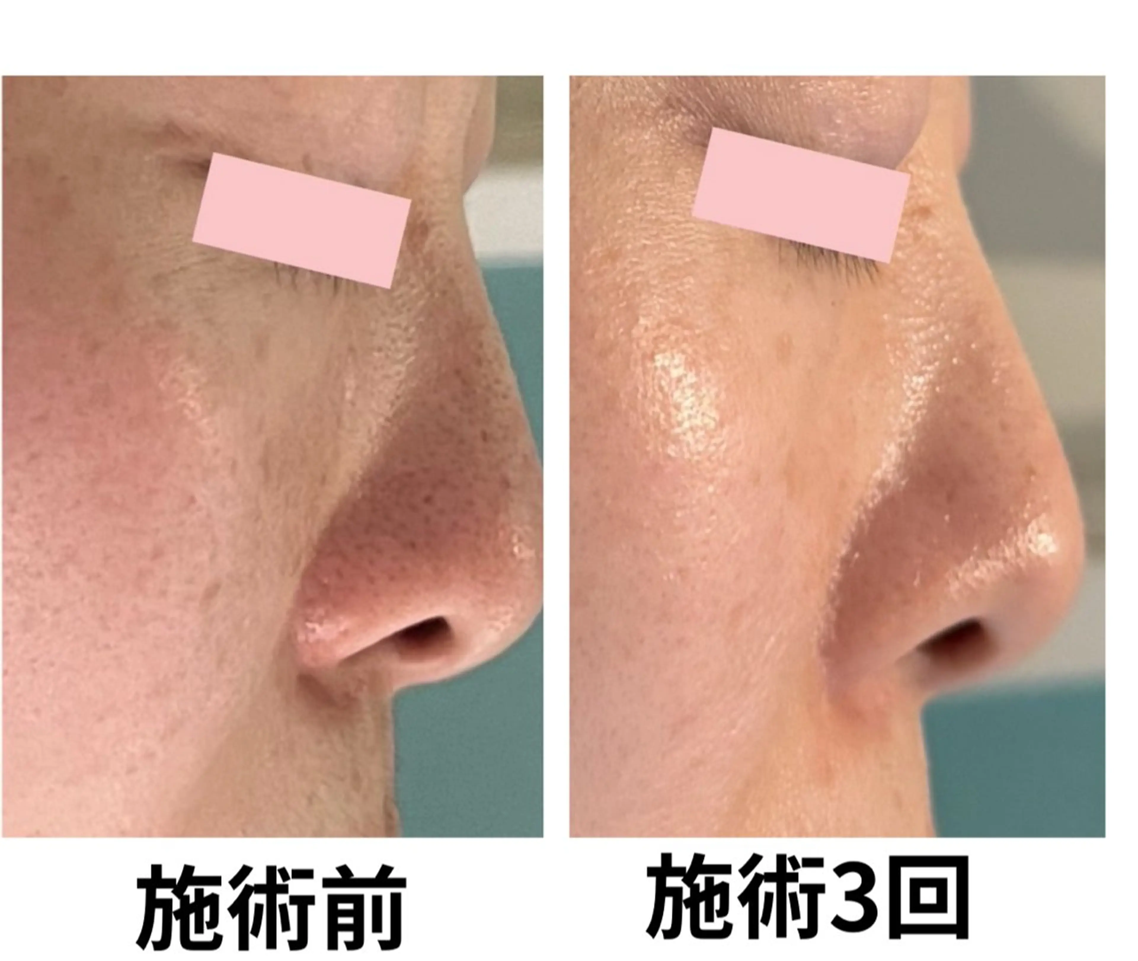 フェイシャルエステサロン 　グレースティー所属・毛穴・ニキビ専門 エステグレースティーのエステ・リラクイメージ