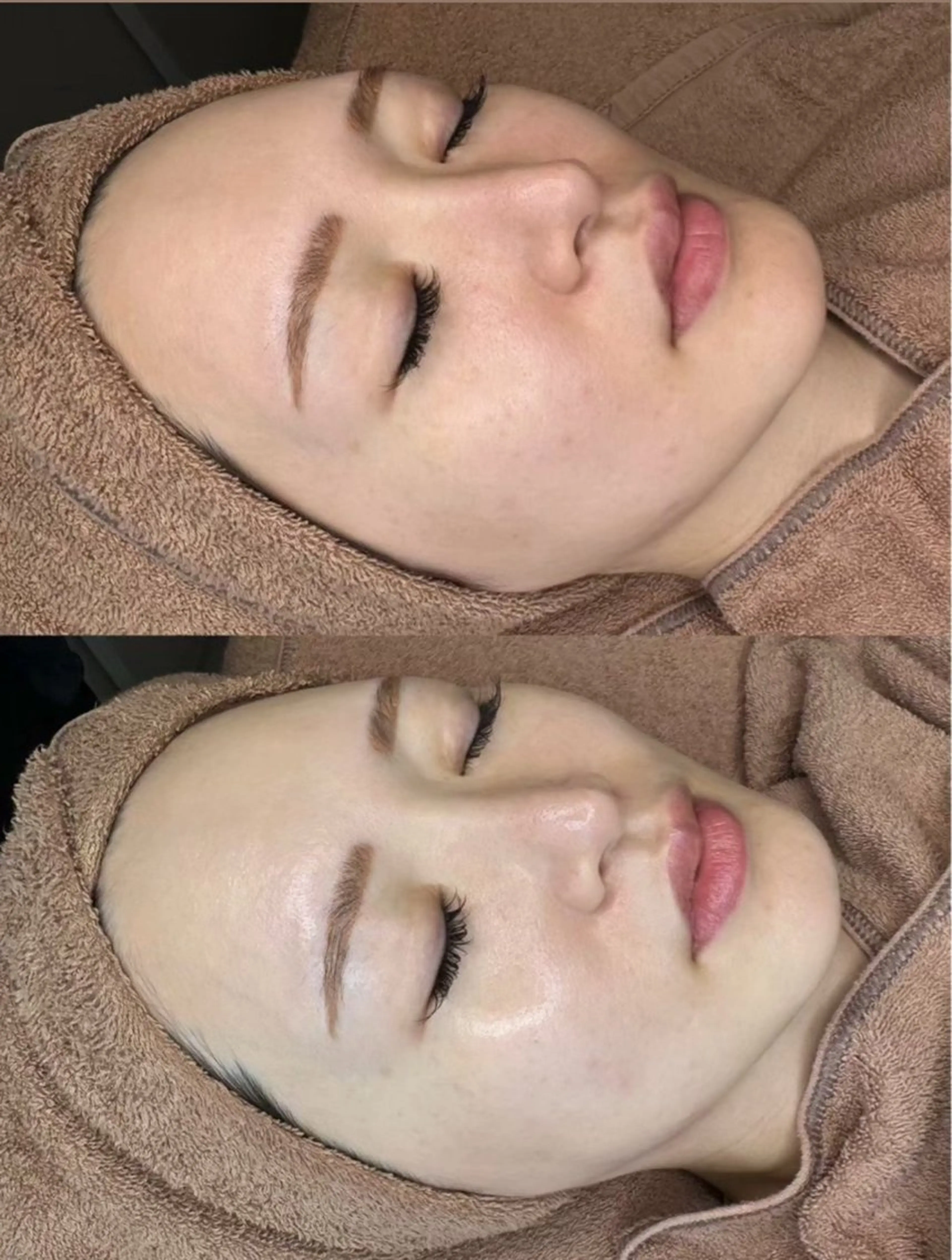 ✨✨️地域最安値✨️✨️ミニモ特別価格🌈練習モデル🍀ララピール★肌を育てる剥離しないピーリング🫧✨全顔施術の写真