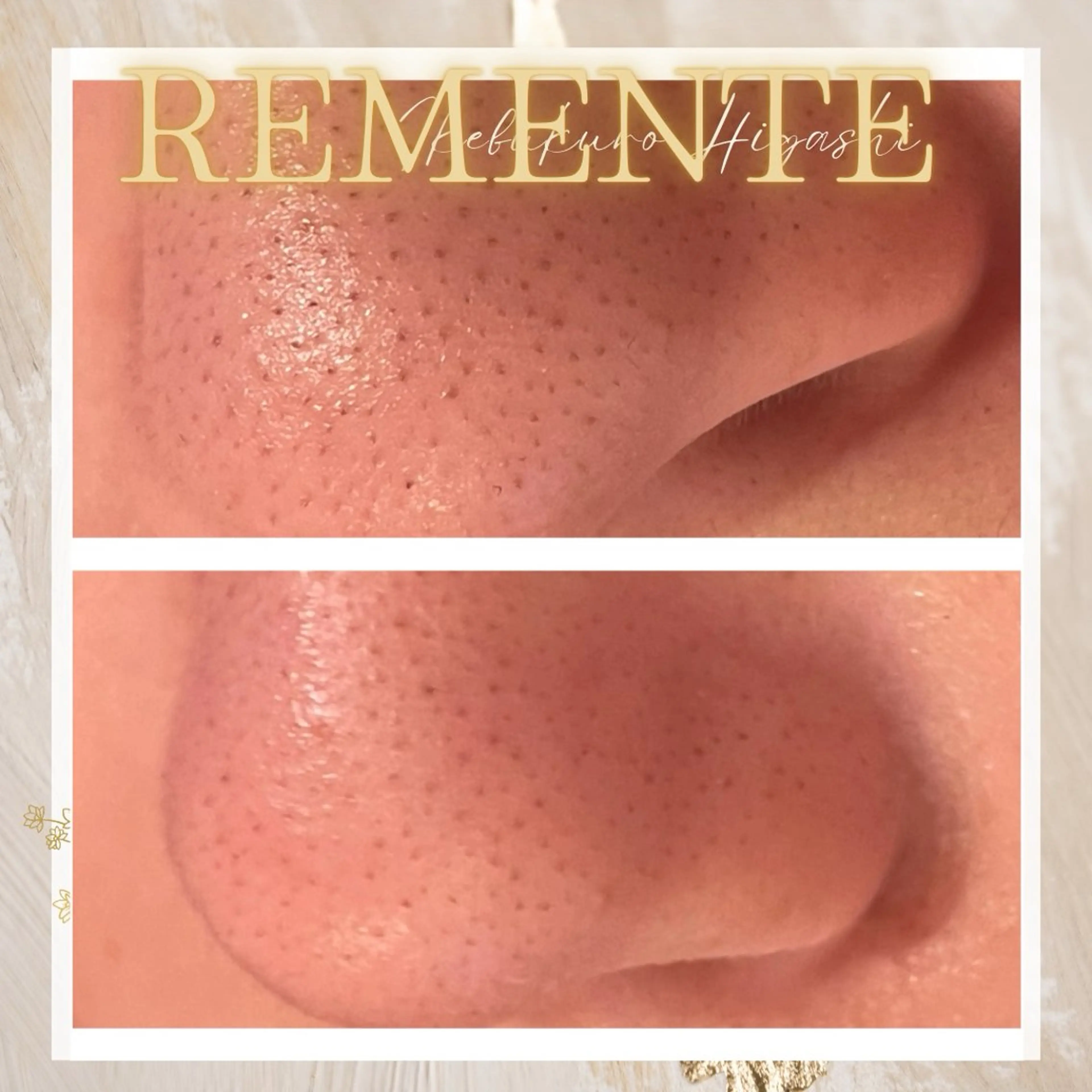 【当日予約限定】★口コミ記載で半額以下に★毛穴の汚れを一掃★ハイドラフェイシャル（毛穴洗浄）！！ニキビや黒ずみに効果ありの写真