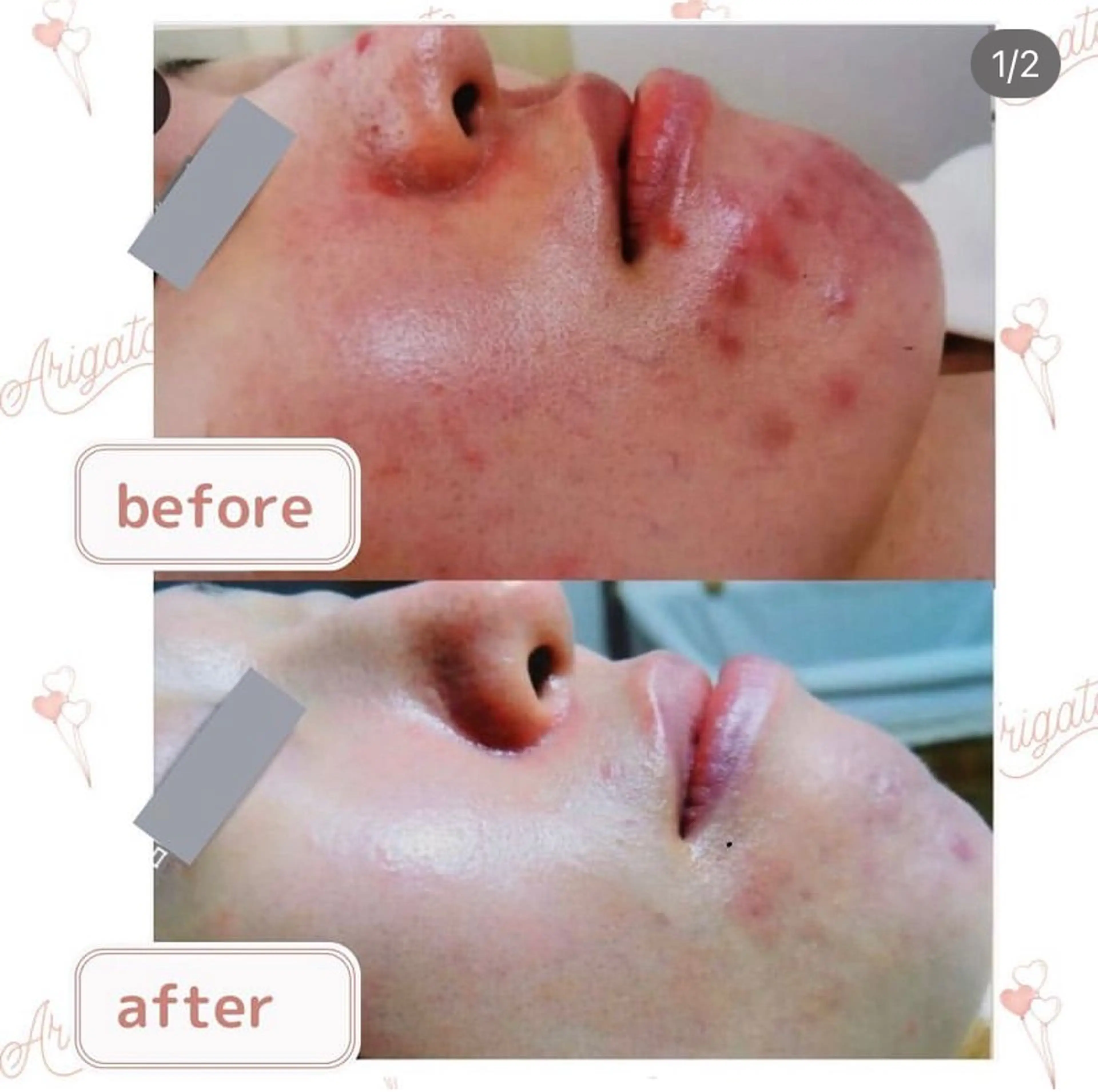 ニキビケア◇ニキビ跡 レゾン京橋店 八崎のエステ・リラクイメージ