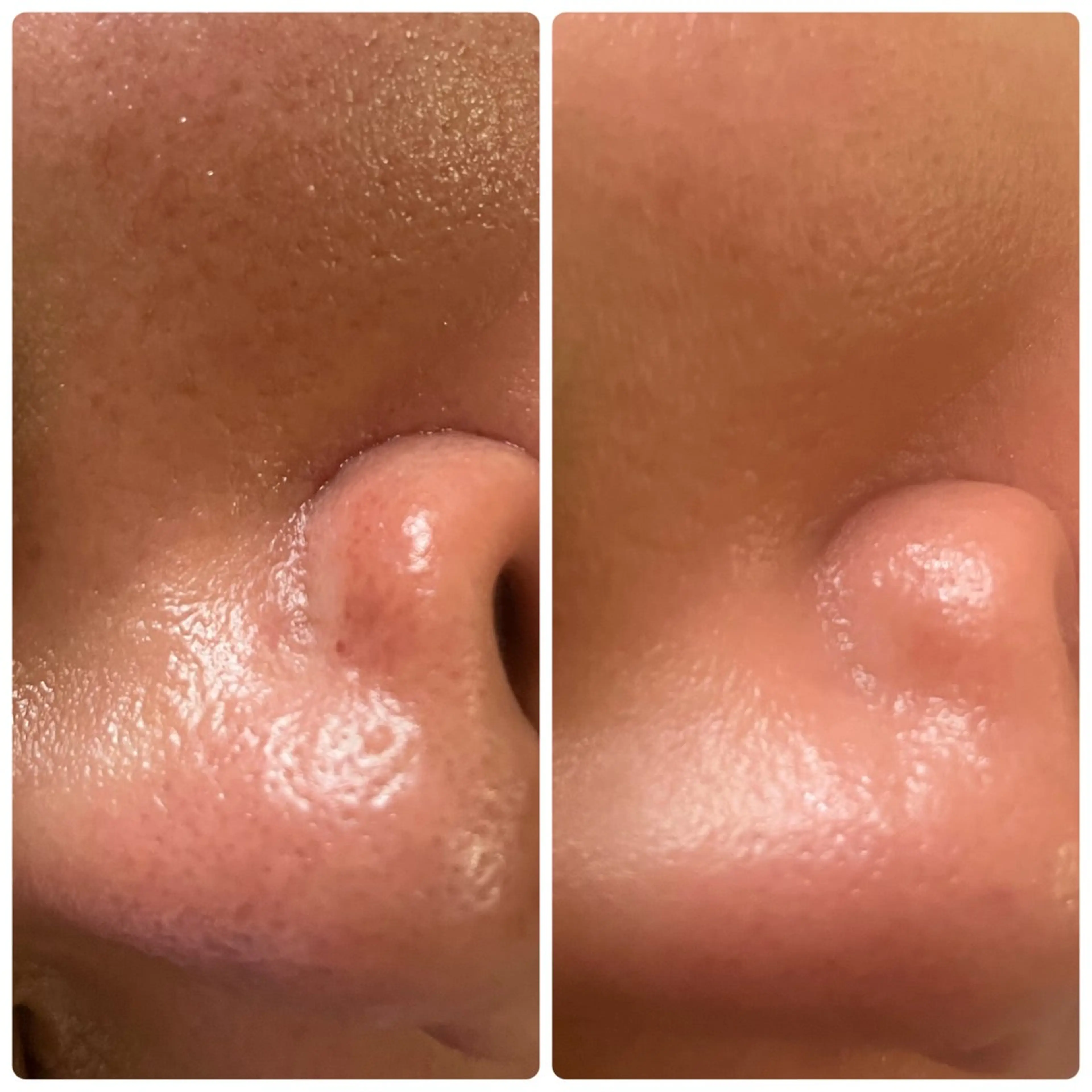 【 夕方割 】 電気美容鍼➕アロマヘッドマッサージの写真