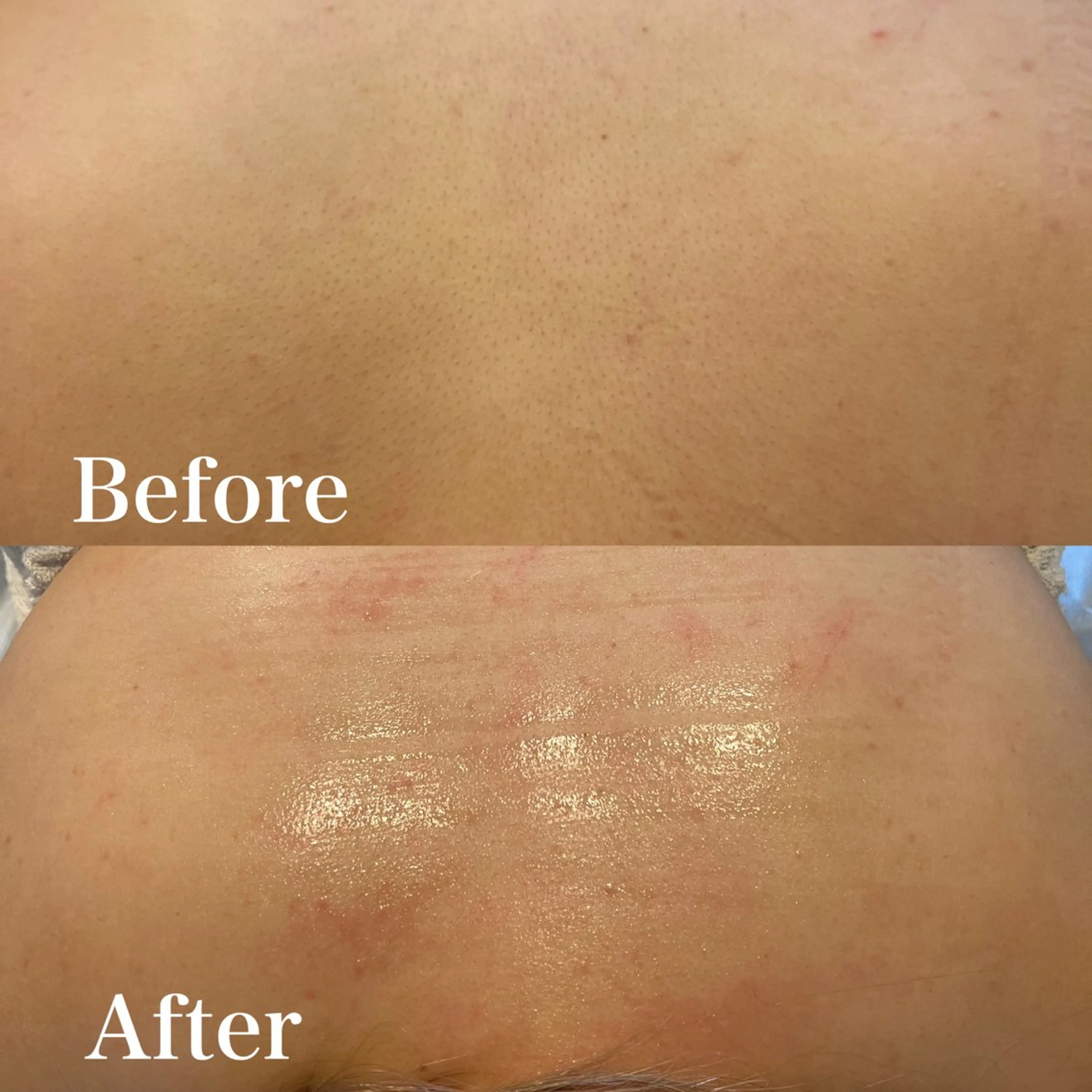 【女性】1部位大パーツ　足（膝上or膝下）・背中（上or下）・腕（肘上or肘下）・お腹（上or下）・バスト・おしり・脇の写真