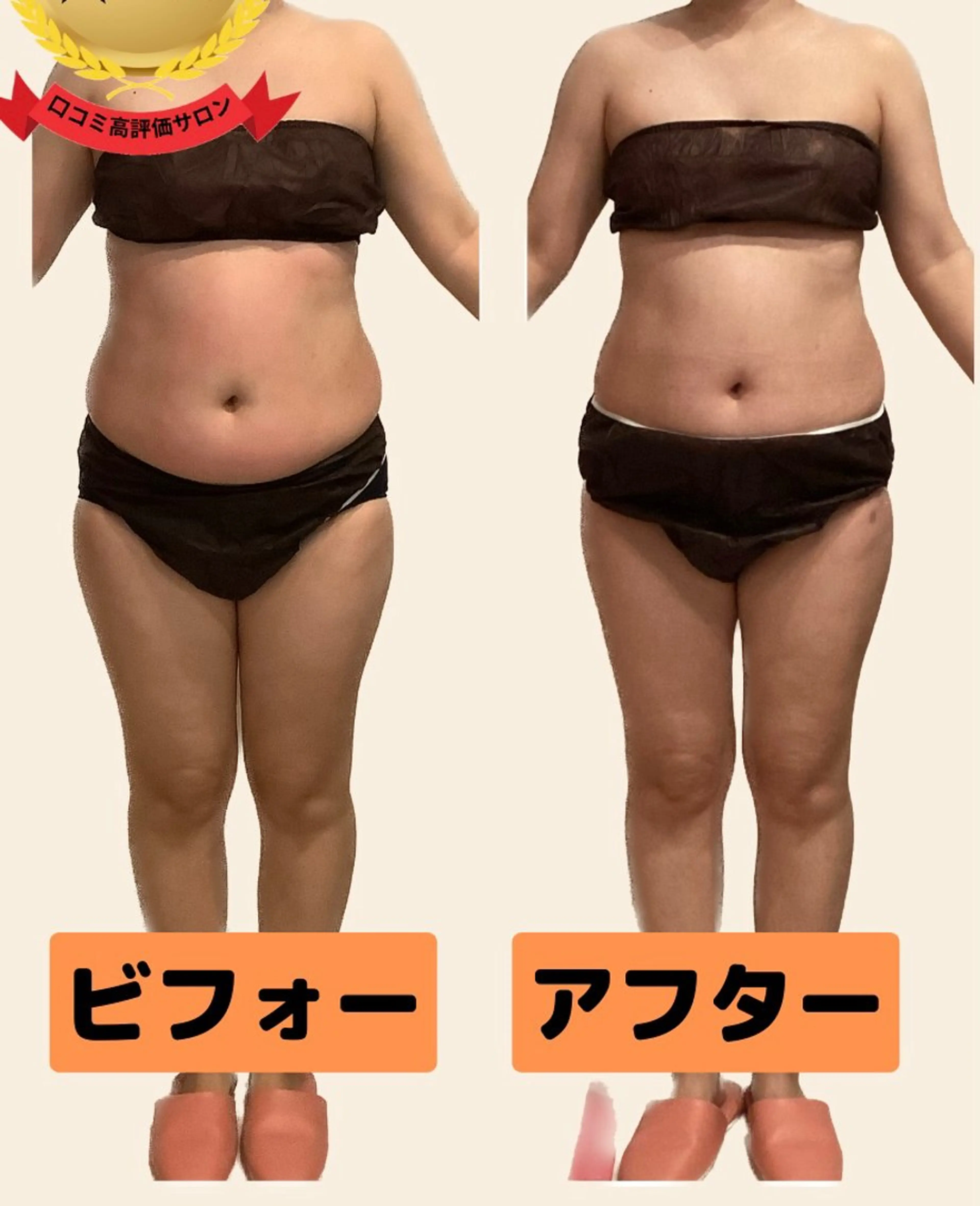 🌟痩身60分🌟ウエスト脂肪ごっそり❗️お腹+くびれ+下腹部集中オーダーメイド60分(キャビ+ラジオ波+吸引/EMS)の写真