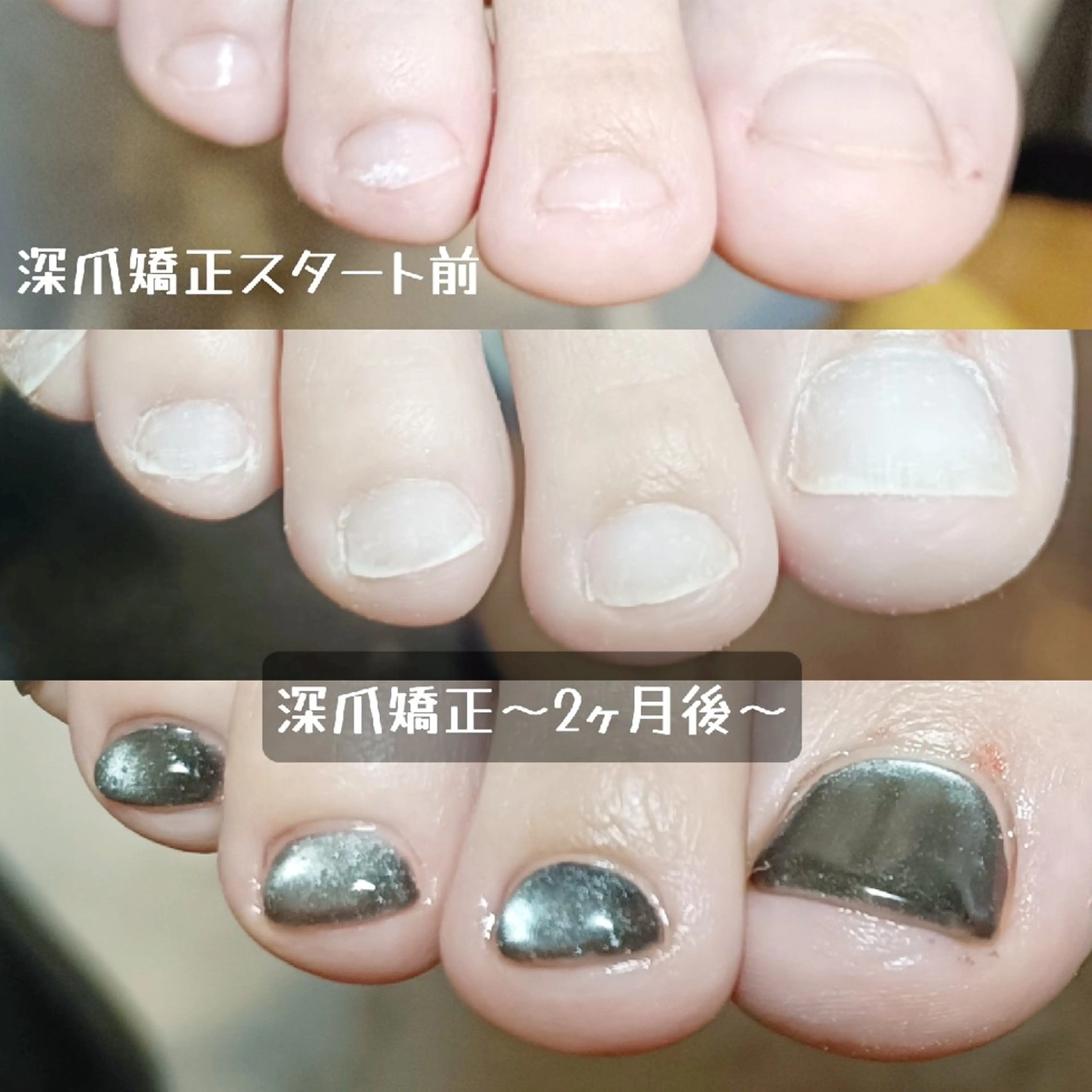 ネイル フットネイル フットネイル 深爪矯正/爪育成ケア manie nailのネイルデザイン