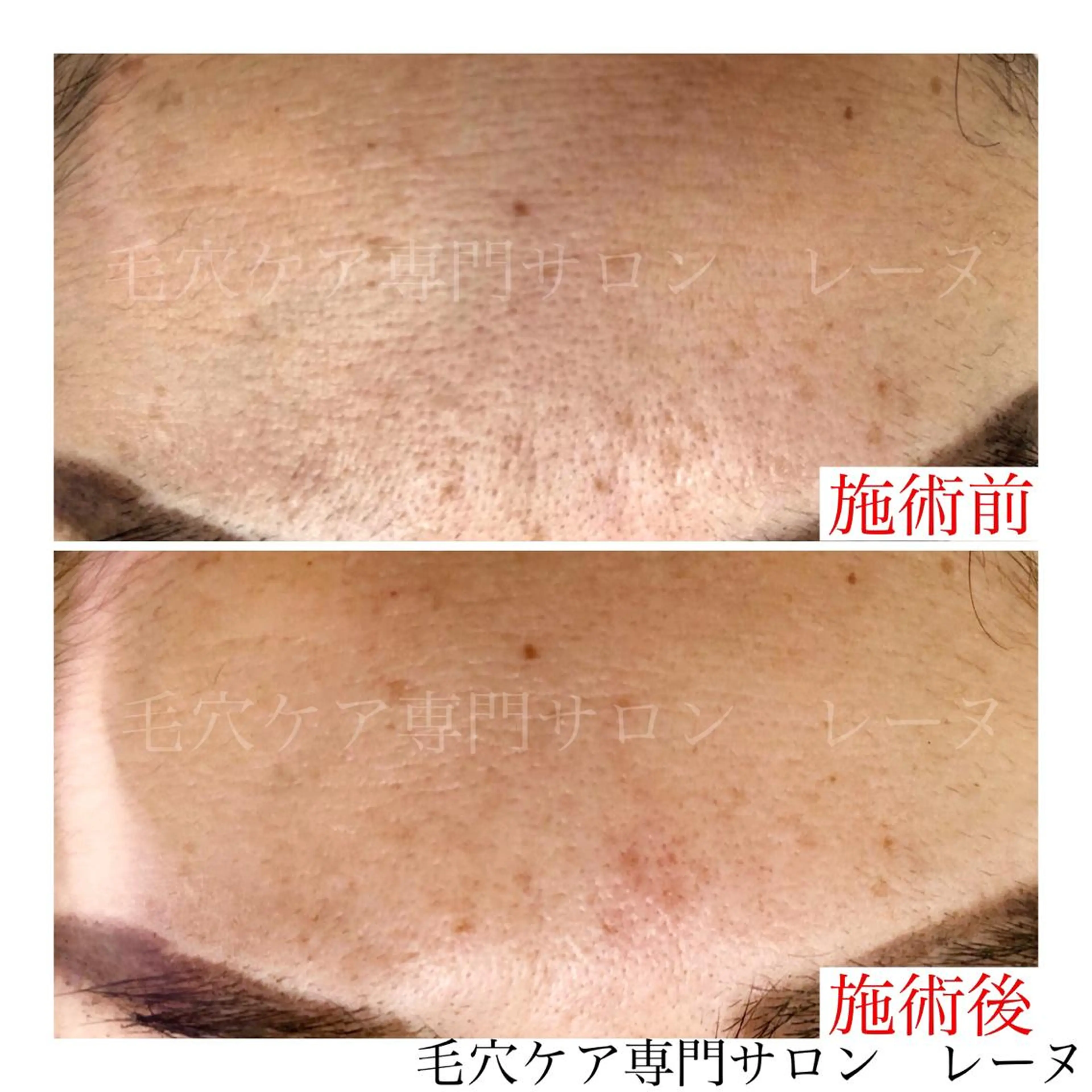 毛穴ケア専門サロン レーヌのエステ・リラクイメージ