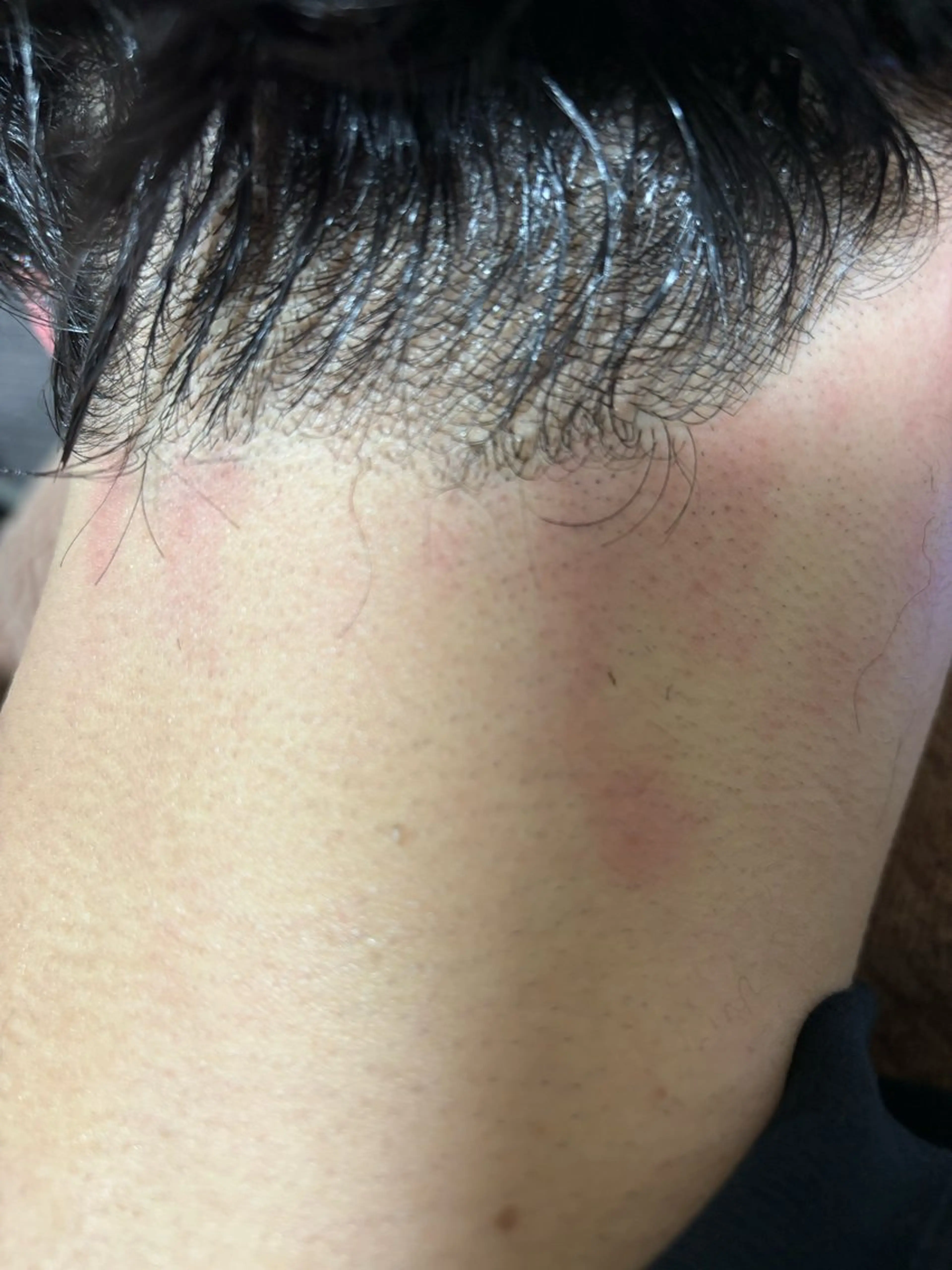 メンズうなじ脱毛   以外と気になる男性のうなじ、清潔感アップまちがい無し‼️の写真