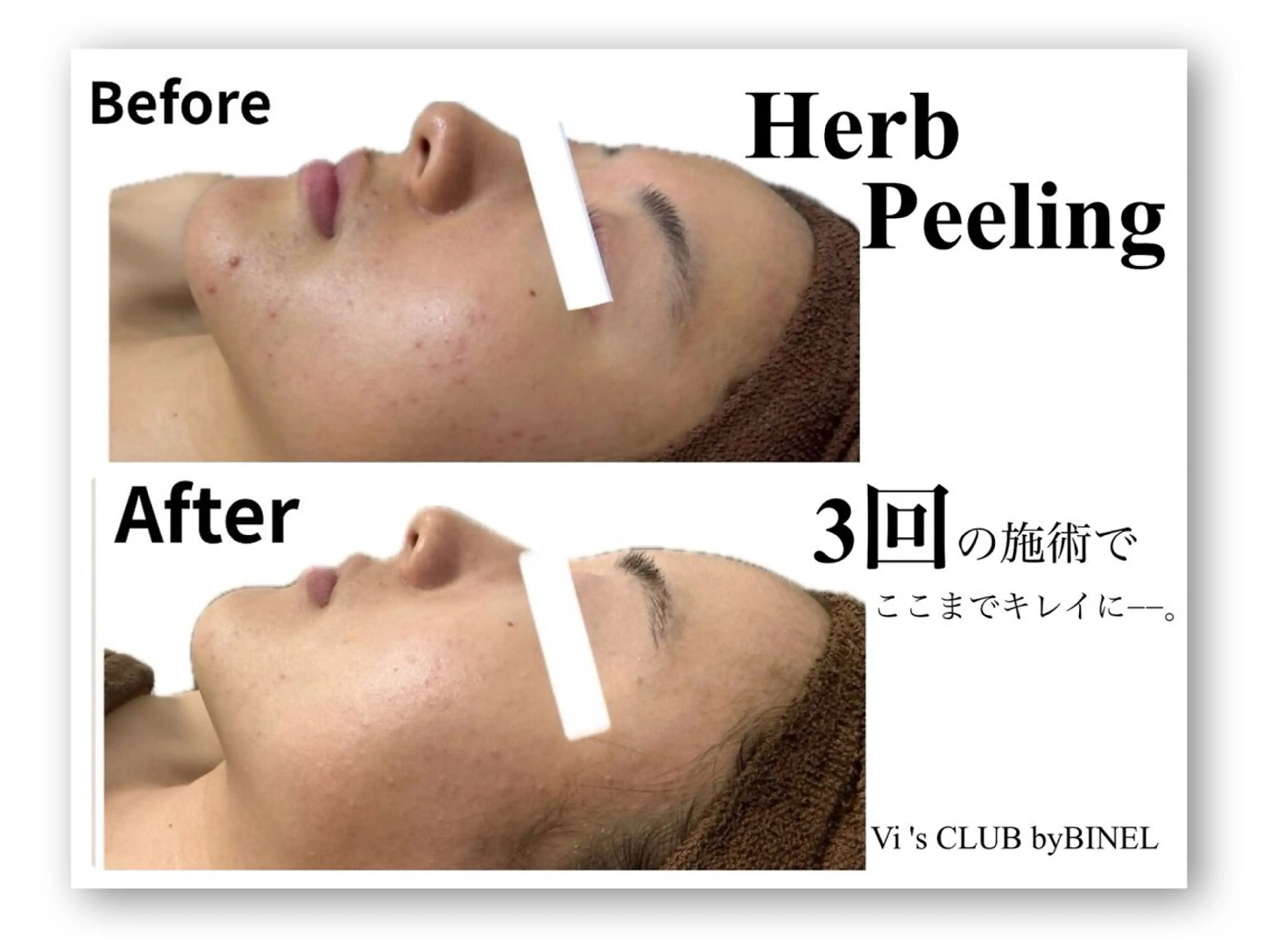 毛穴レス！即質改善ハーブピーリング 60分の写真