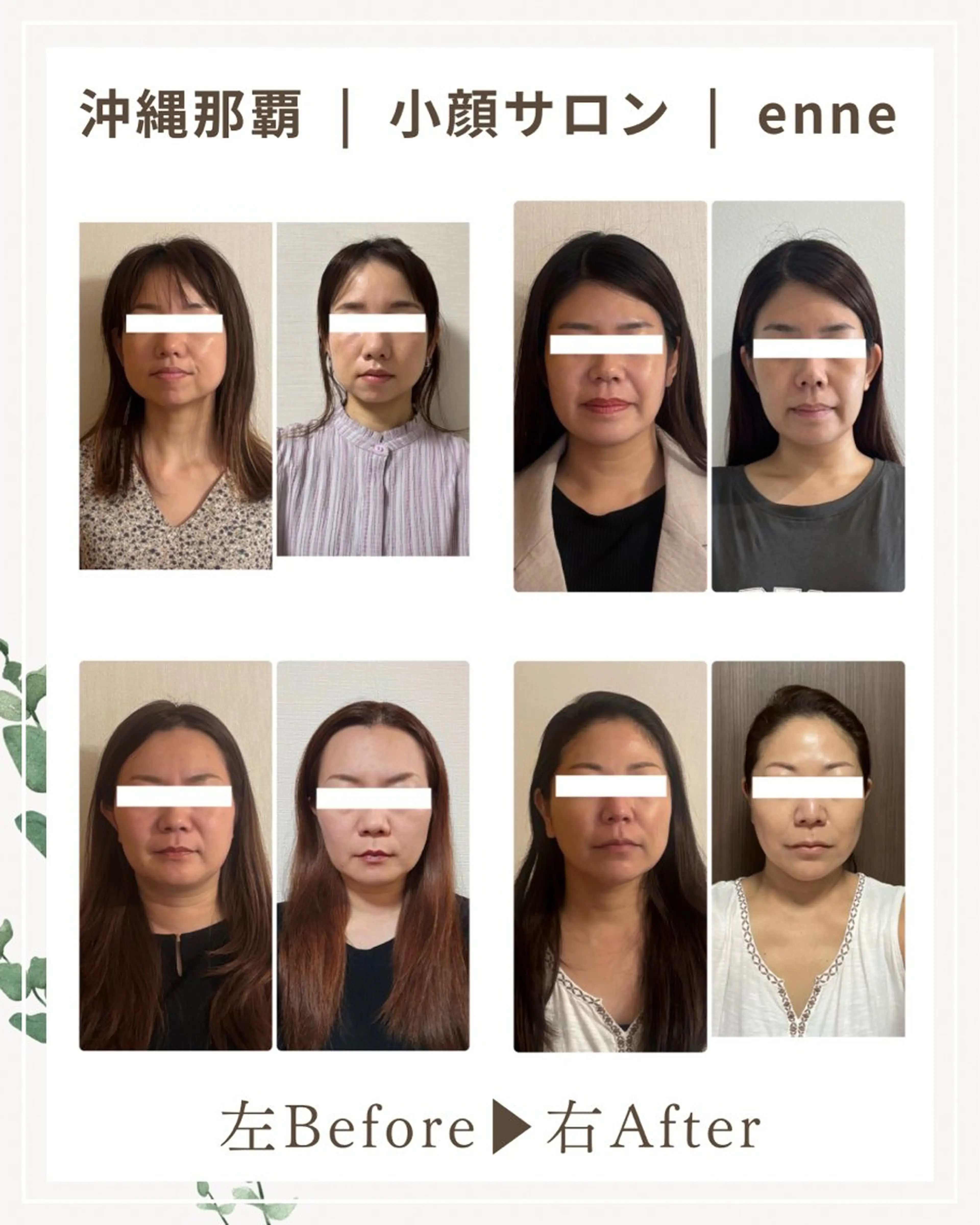 小顔矯正(ミニモ限定価格)※期間限定の写真