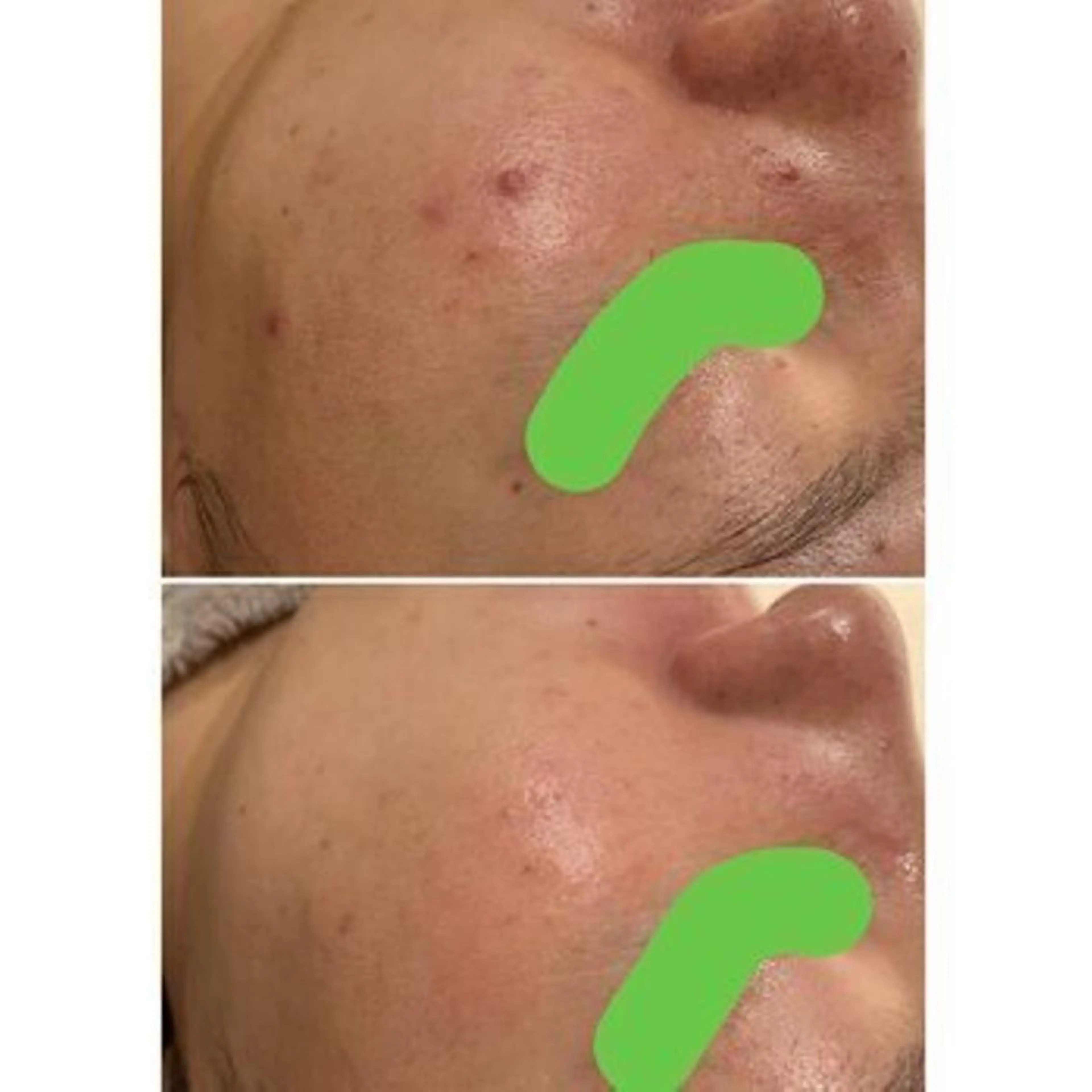 エステ リラク 学生ニキビ改善🍀 優しい肌質改善のエステ・リラクイメージ