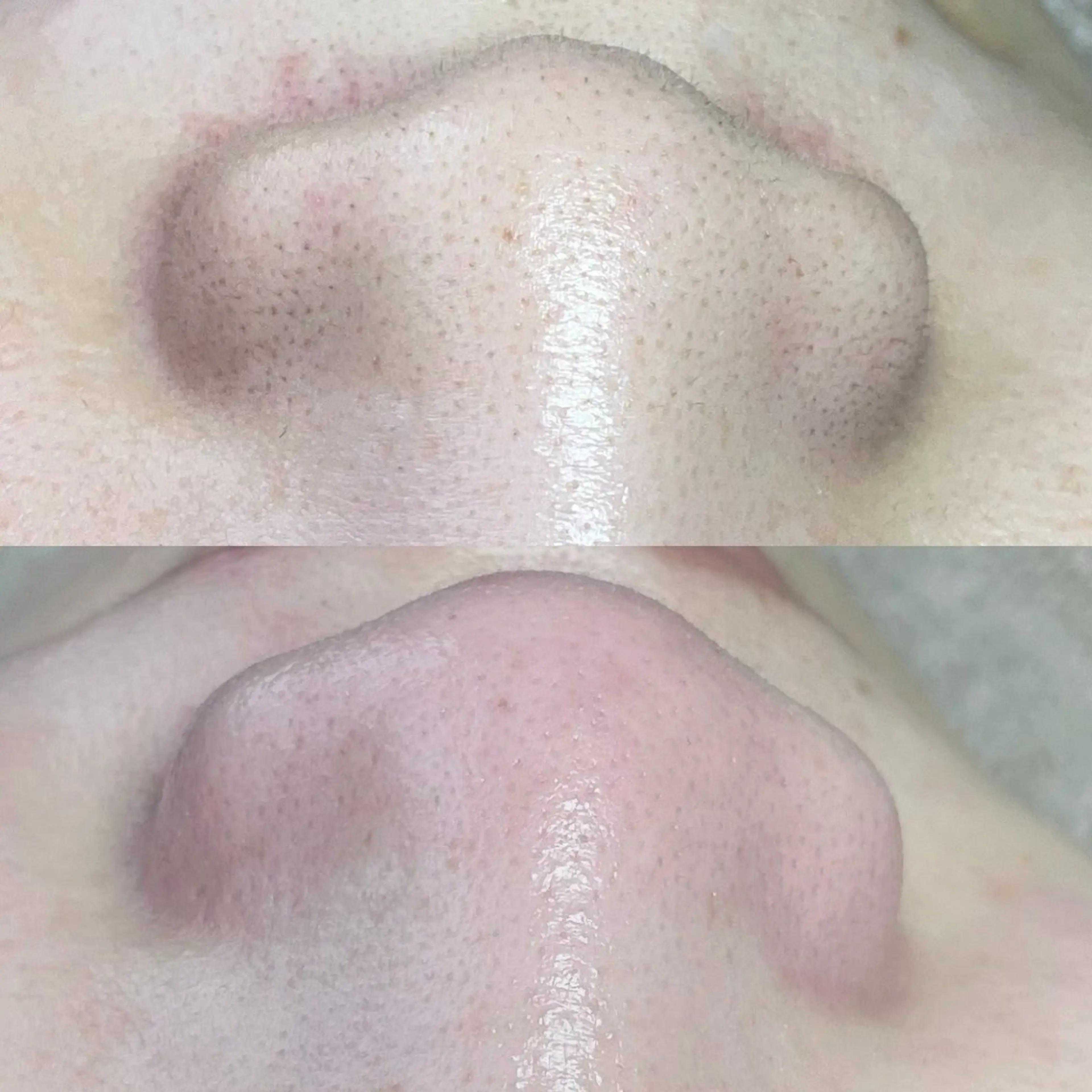 【毛穴➕白玉ピール🫧】毛穴エクストラクション陶器肌コース初回　エクストラクション➕デコルテマッサージ（120分）の写真