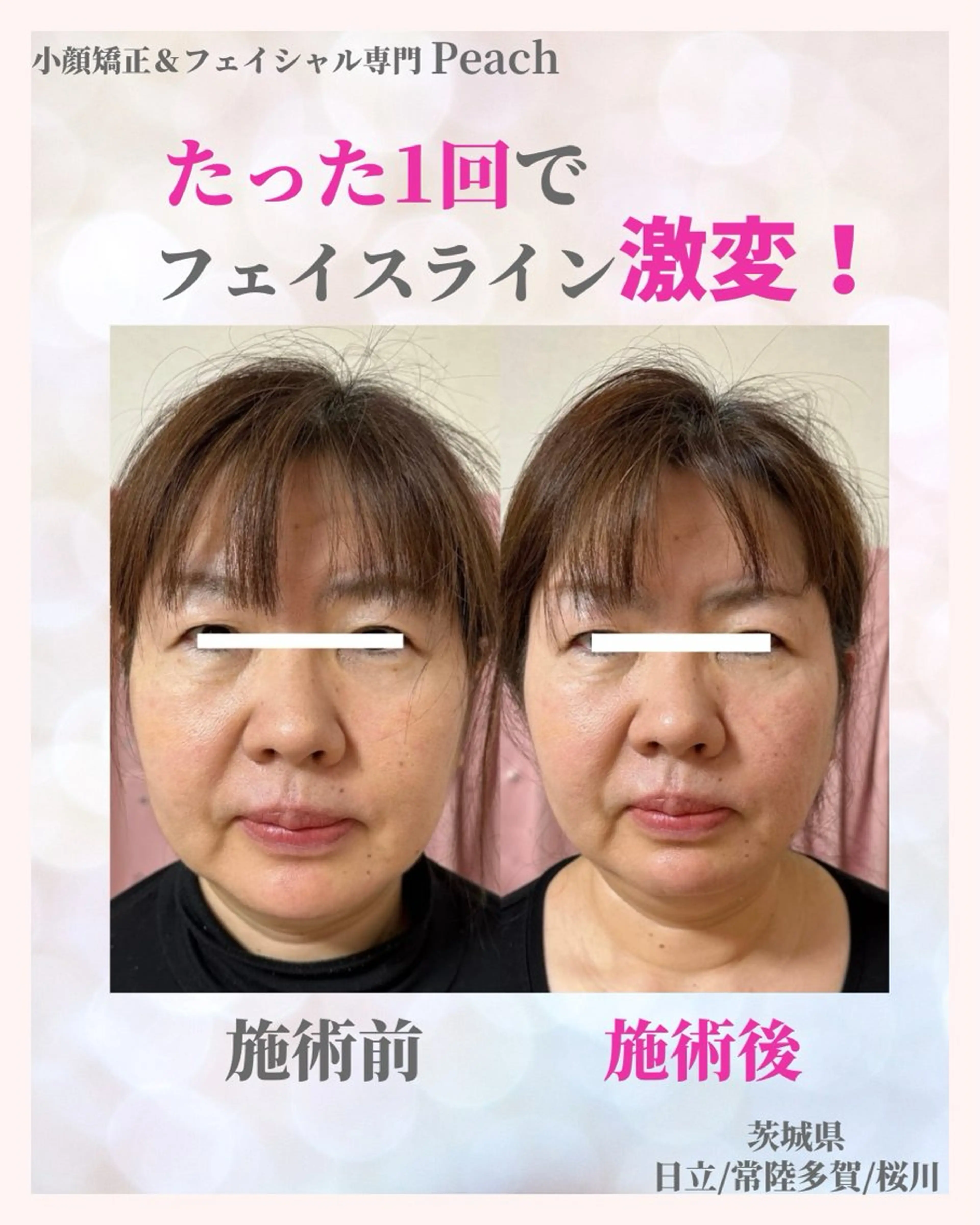 痩身・小顔・骨盤矯正×ヒップアップ専門エステ Peach所属・桃尻つかさ🍑小顔× ノーファンデ肌作りのエステ・リラクイメージ