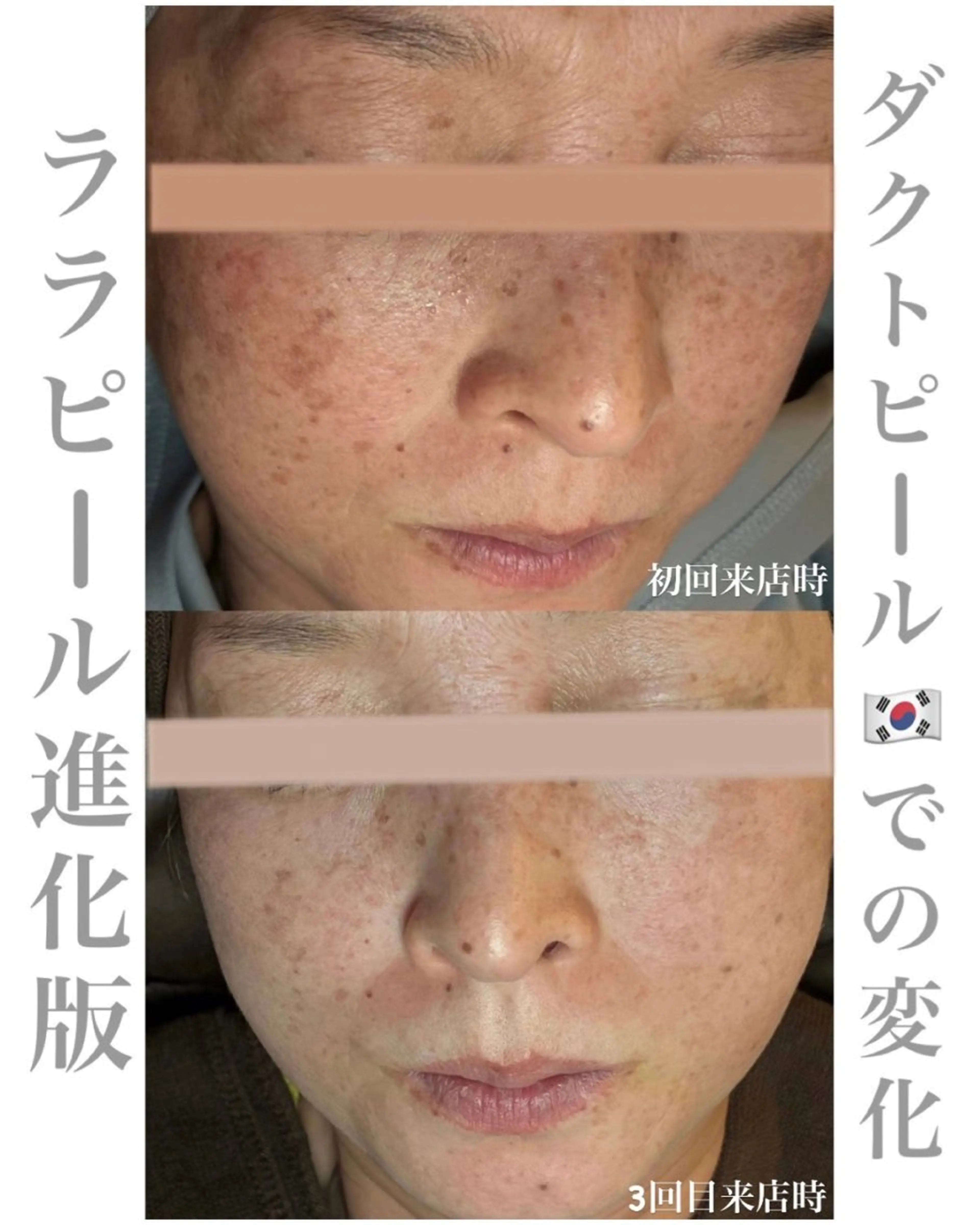 【モニターで写真撮影可能な方】剥かない最新ピーリング！ララピール進化版ダクトピール／毛穴・シミ・シワ徹底ケア◎の写真