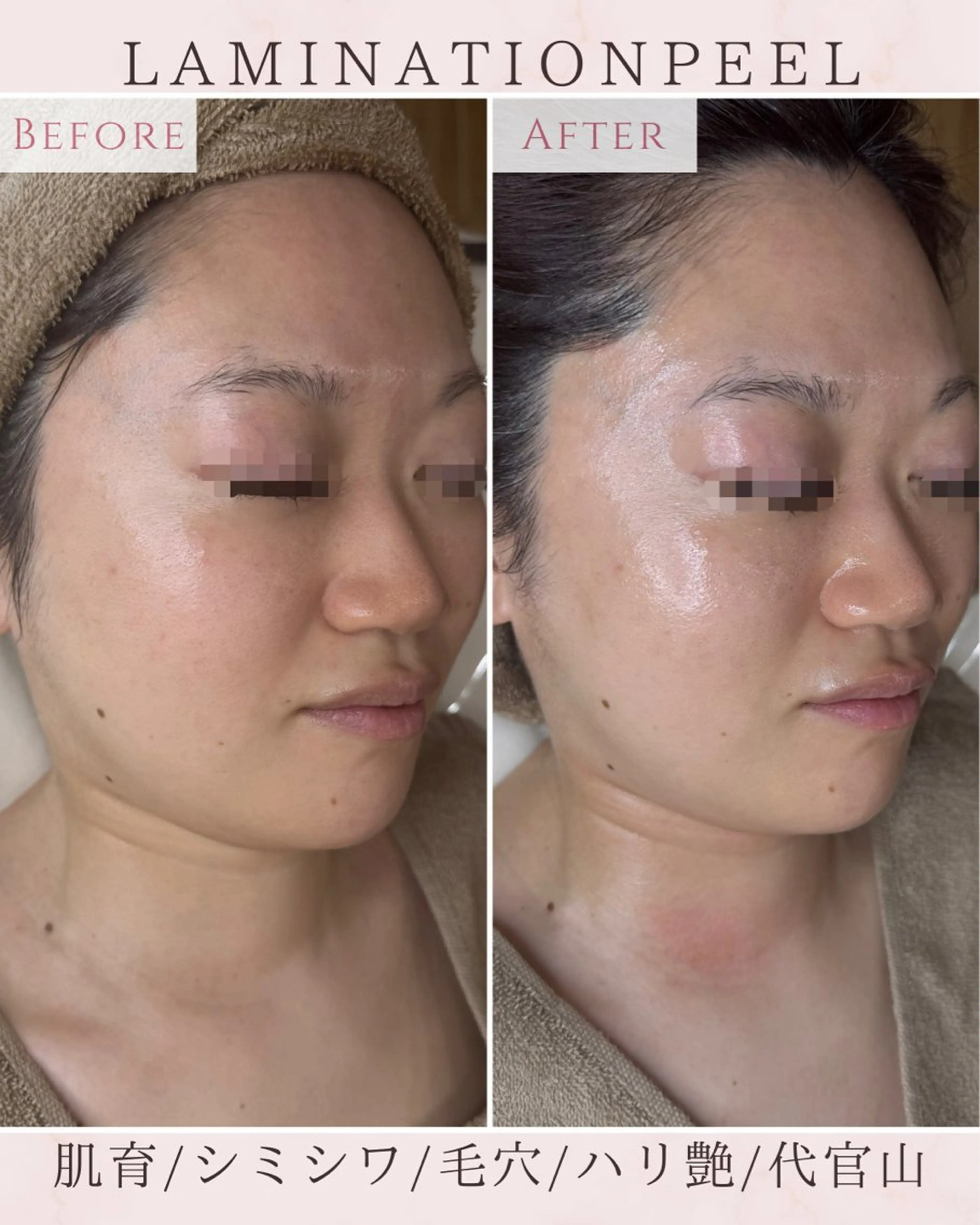 エステ 【ハーブピーリング/韓国ツヤ肌ピーリング】RelierBelle-ルリエベル-所属・肌質改善/肌育特化 プライベートサロンのエステ・リラクイメージ