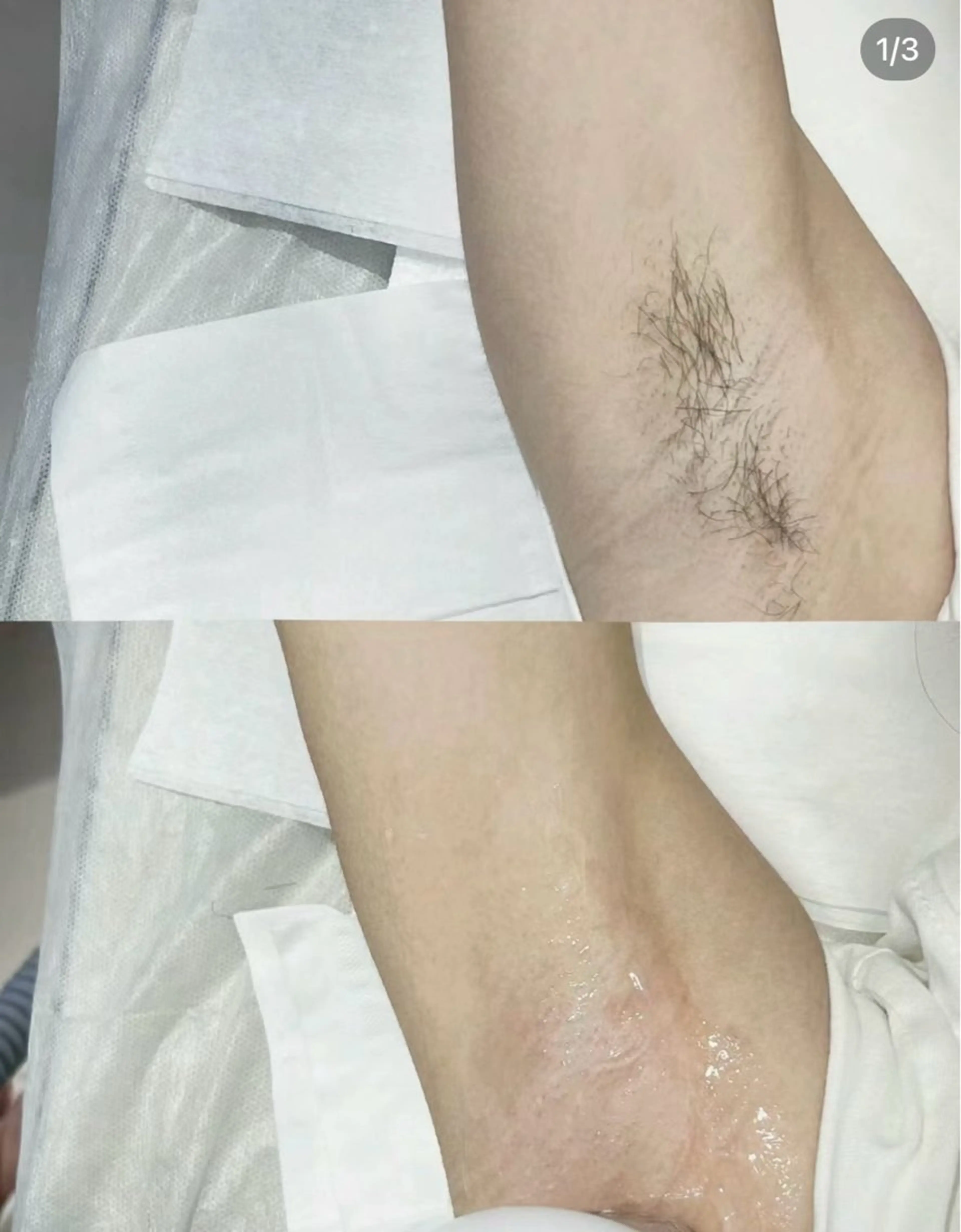 両脇脱毛の写真