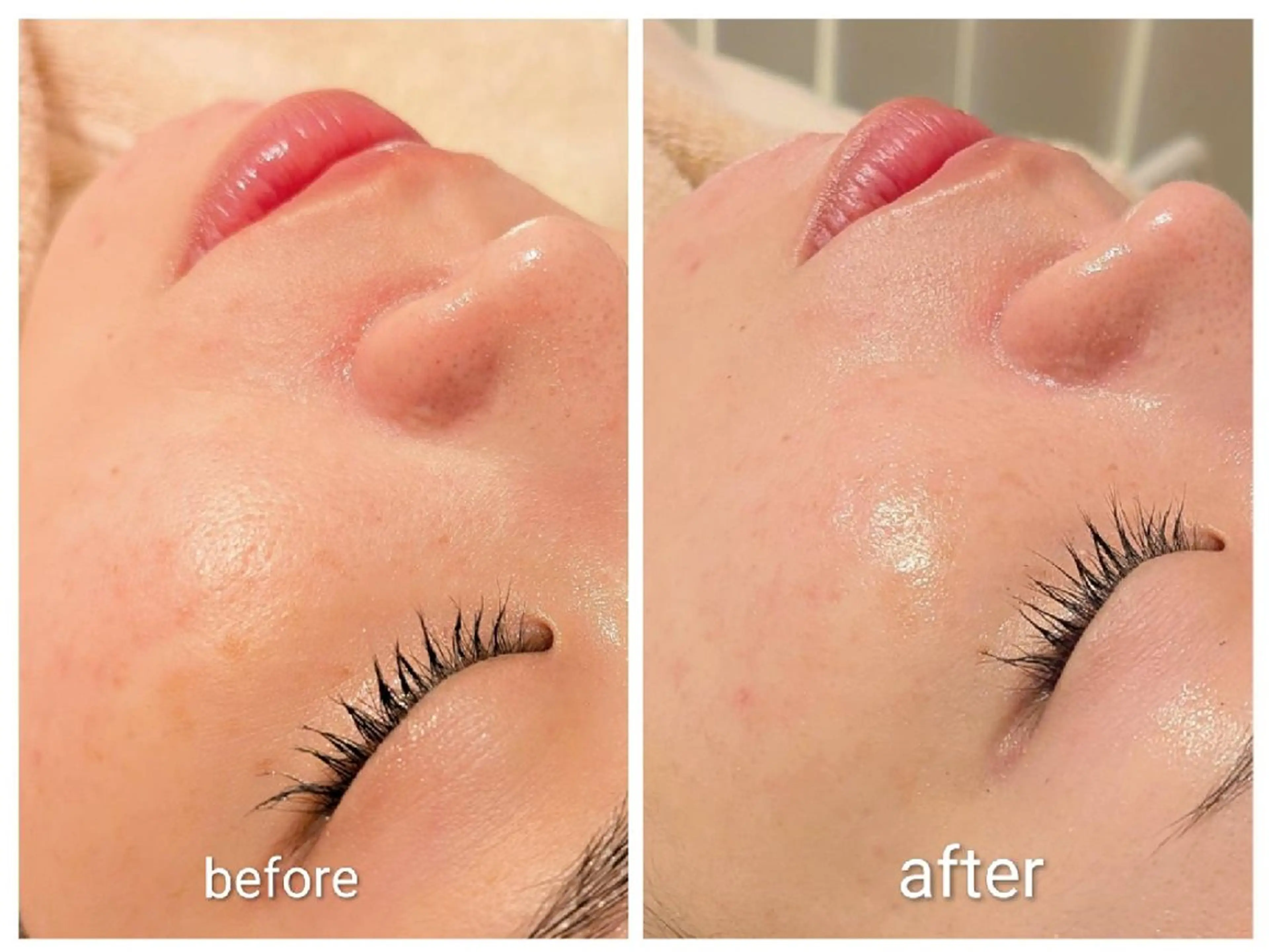 【基本ハーブ】 お肌の整え韓国韓方ハーブピール (ヘッド付)100分13000円の写真