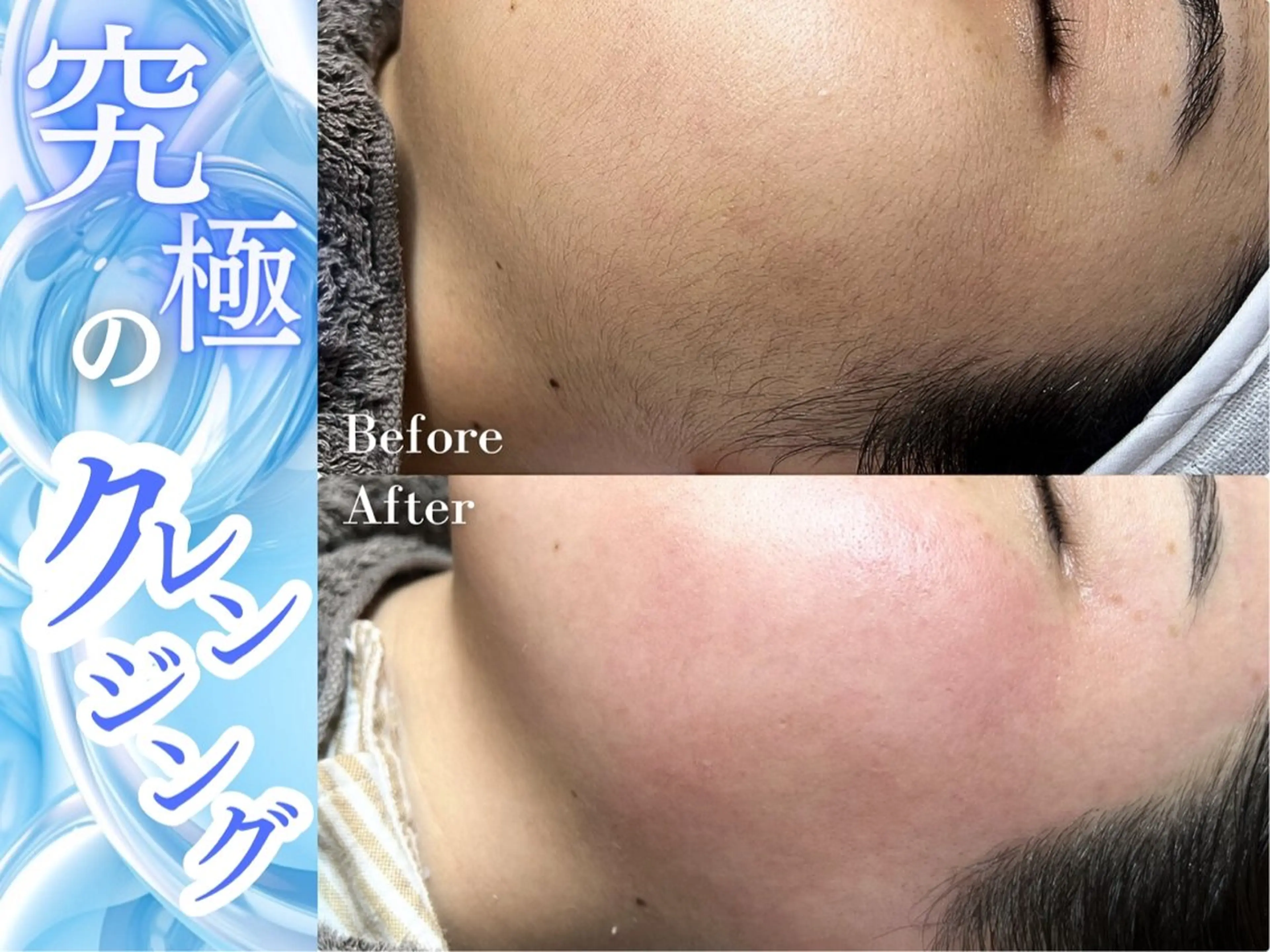 [全顔WAX] シェービングは古い!断然ファイシャルwax(パック付)¥8,800→¥7,500の写真